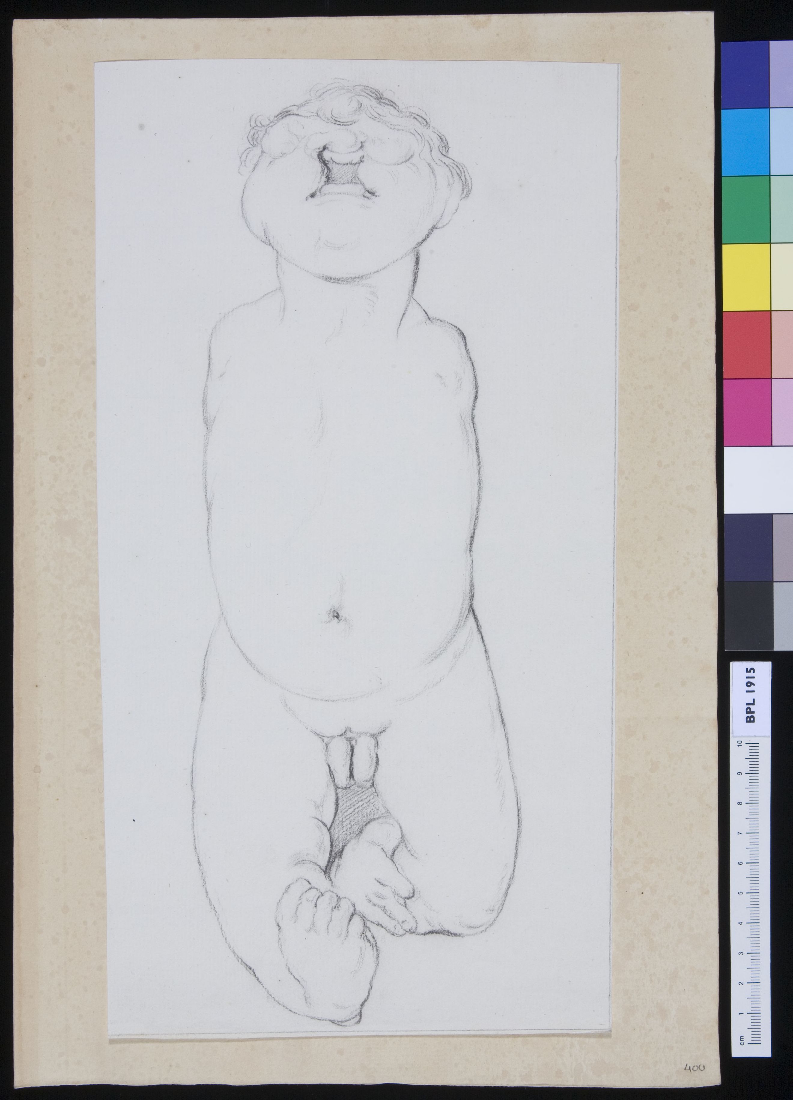 Infant with several deformations
