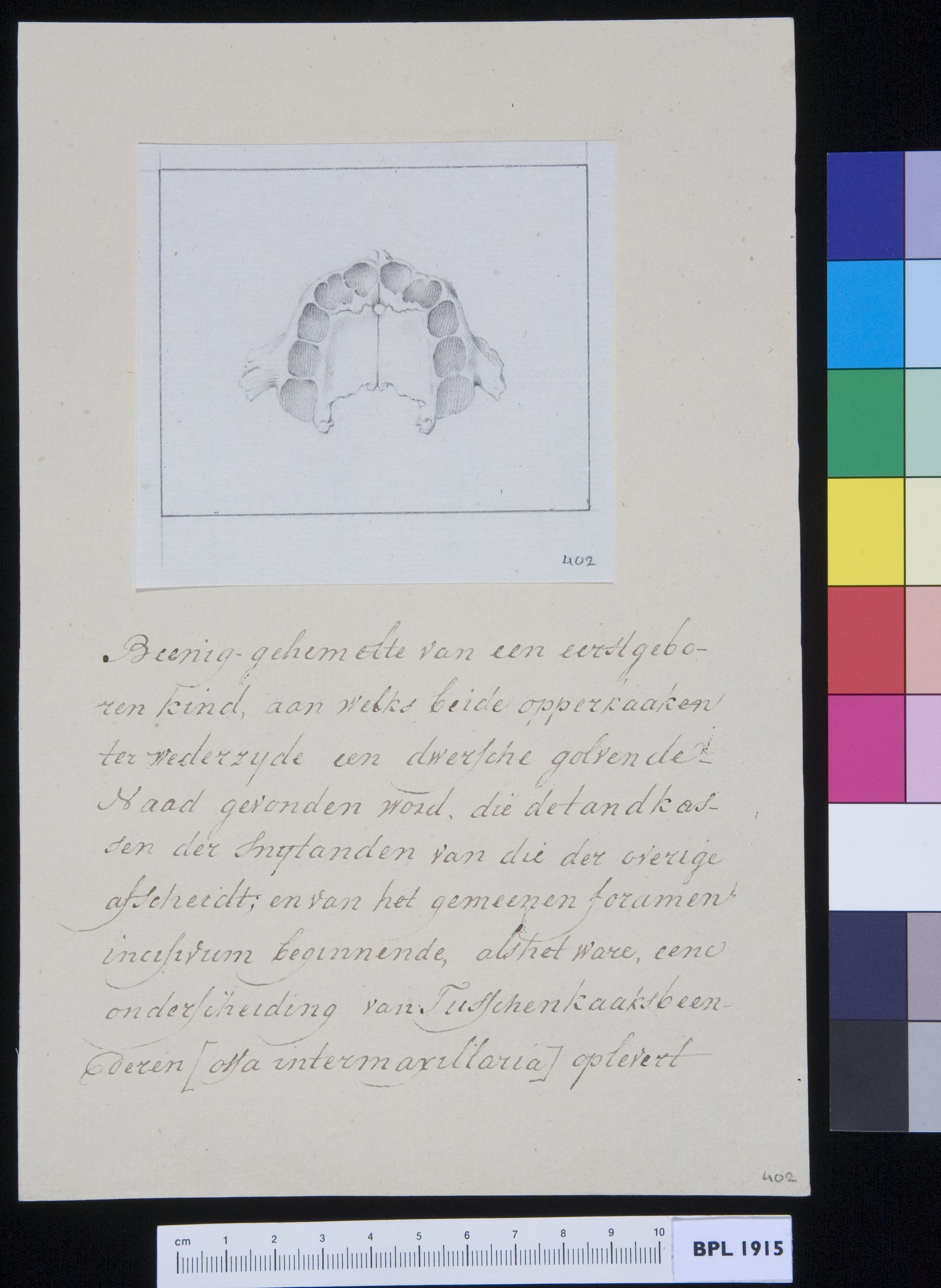 Palate (palatum), with fractures