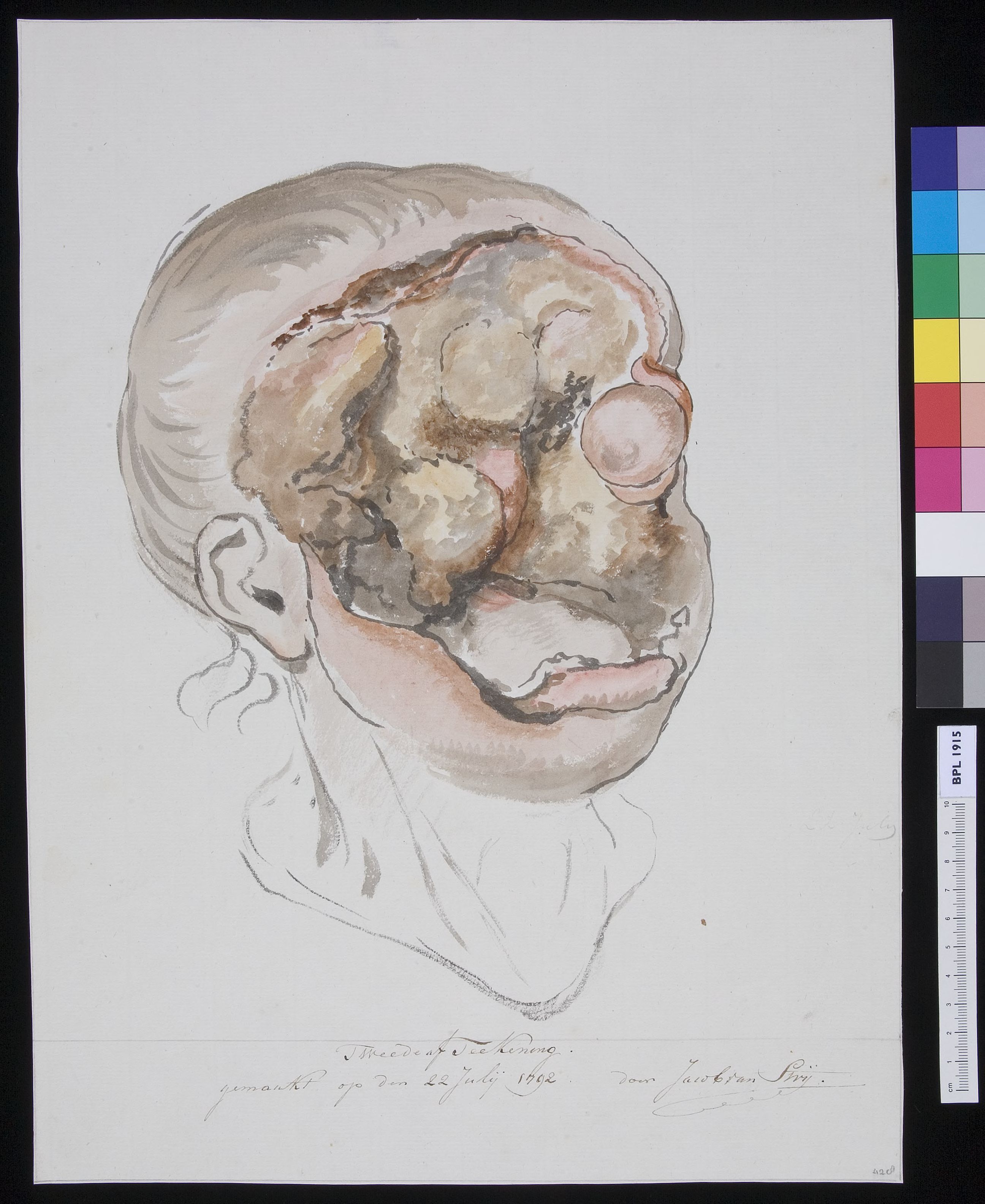 Man with severely deformed face