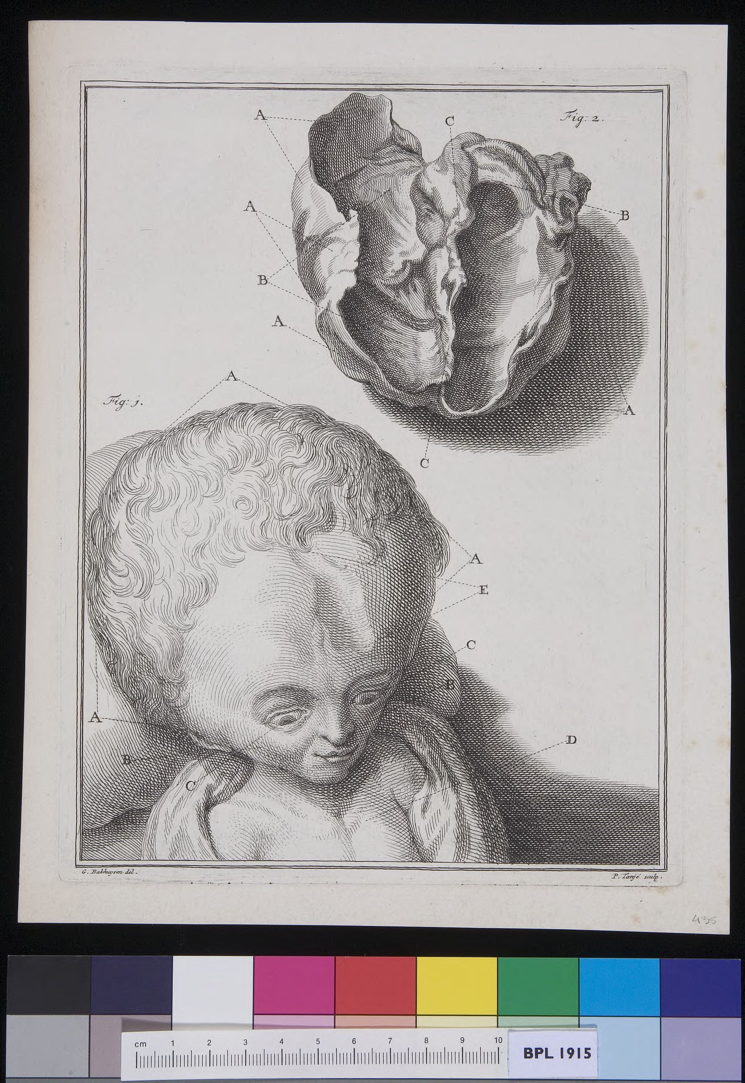 Child with hydrocephalus
