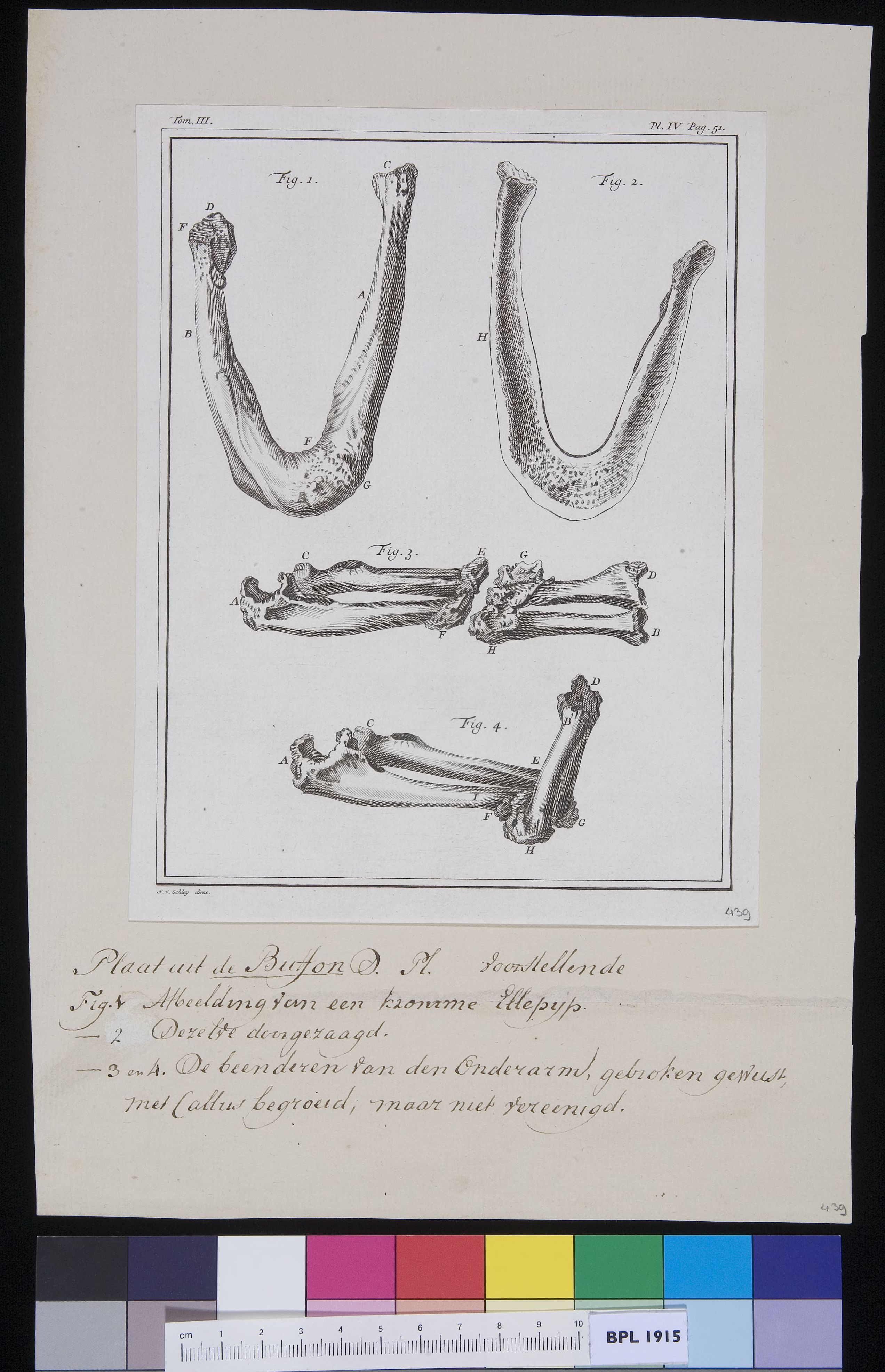 Twisted ulna