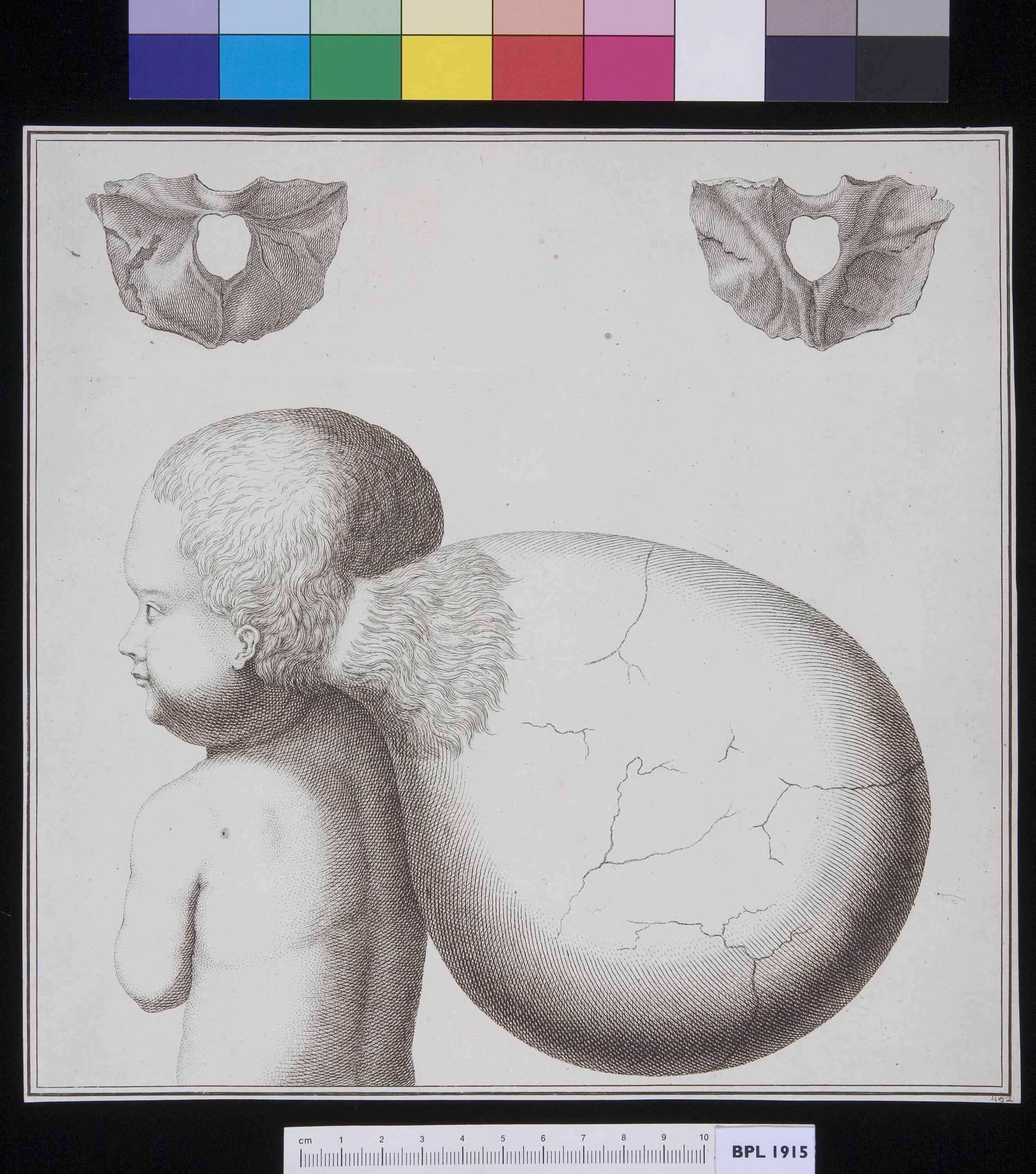Child with tumor in its neck