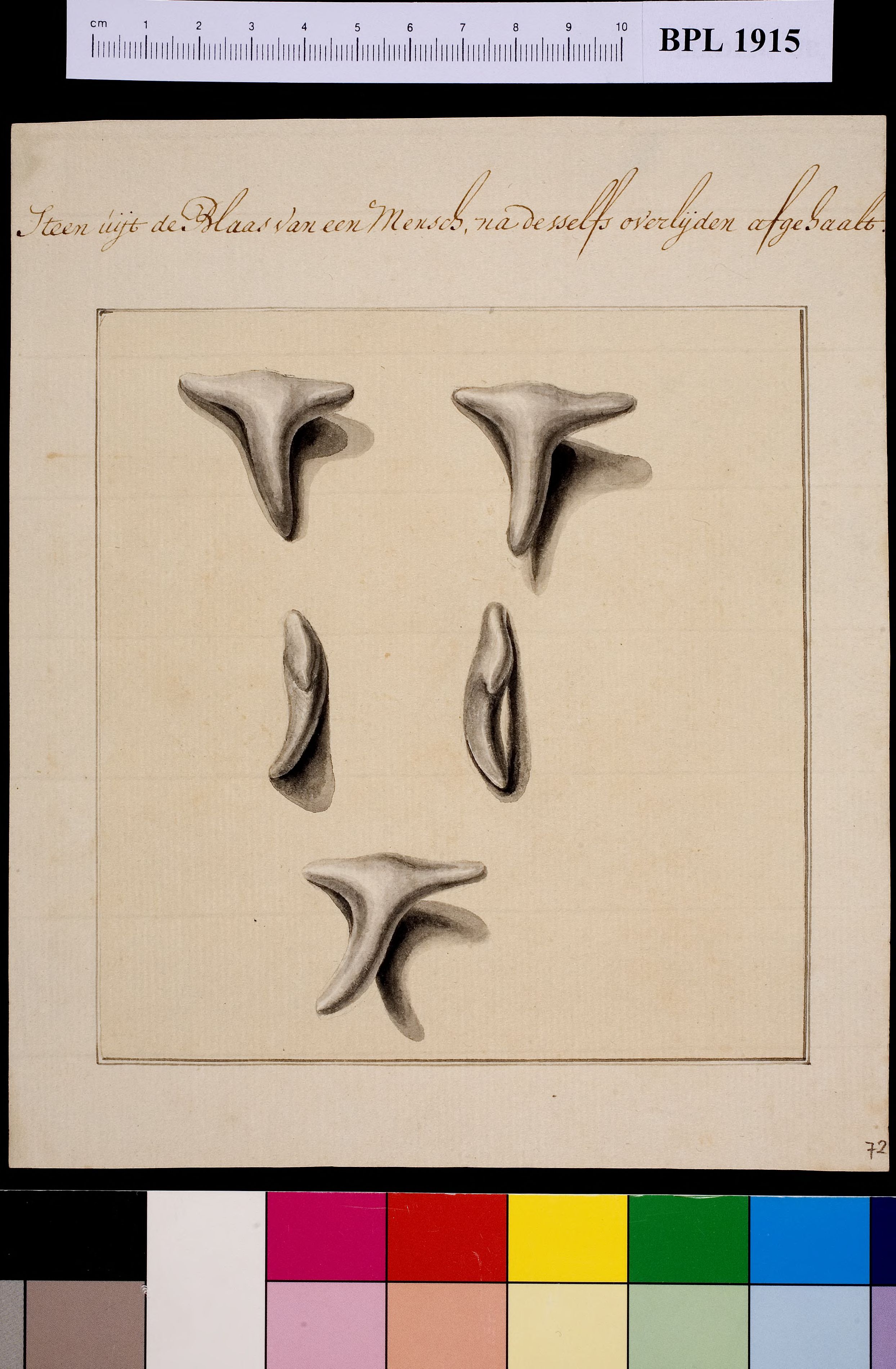Five views of a bladder stone