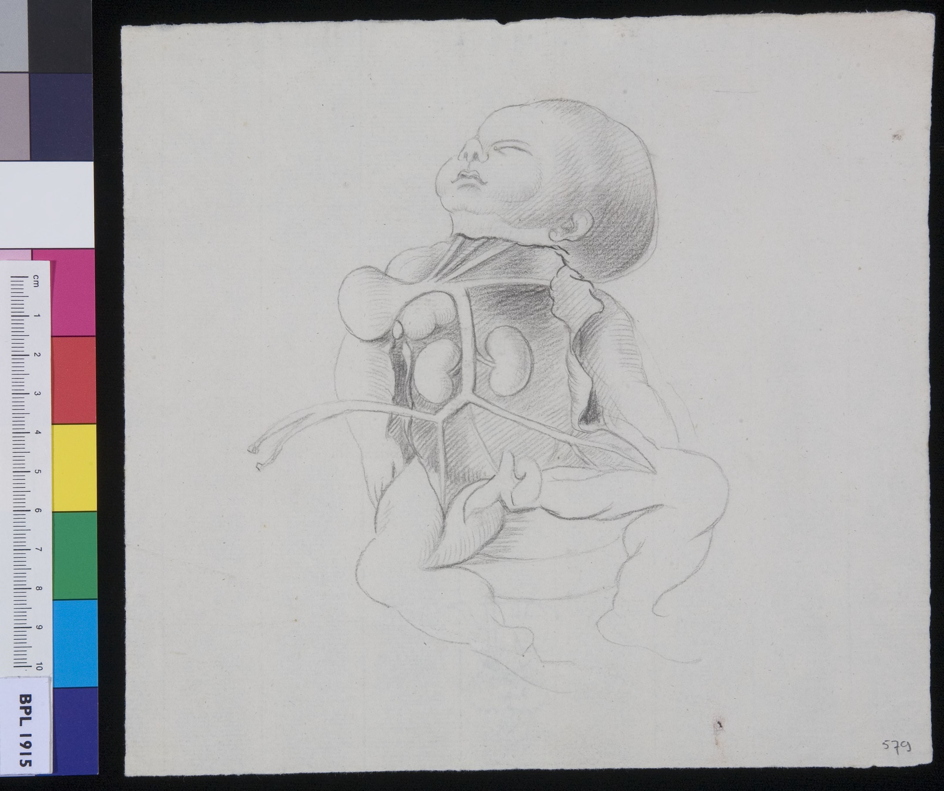 Deformation of the kidneys in an infant