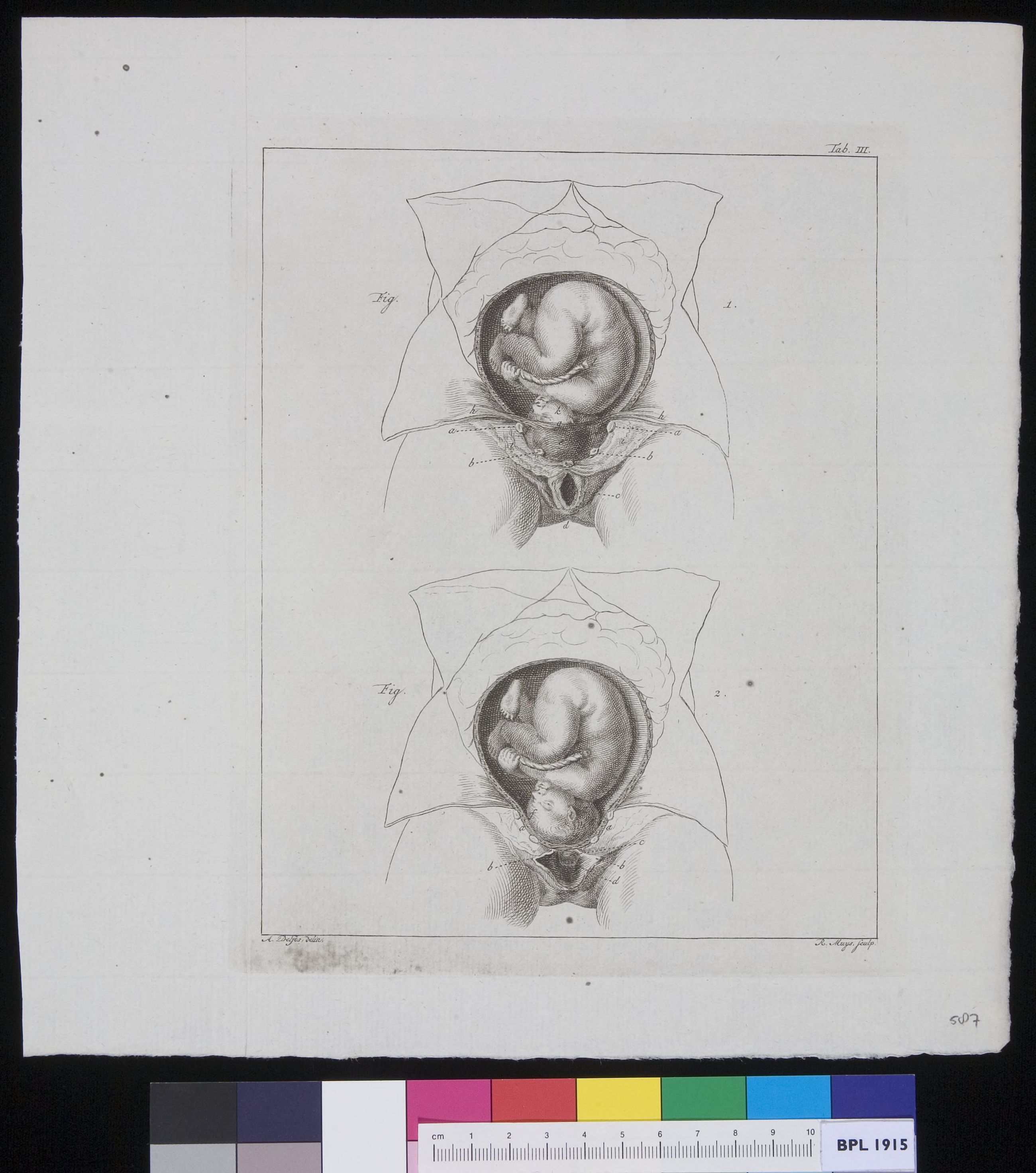 Abdomen with position of fetus