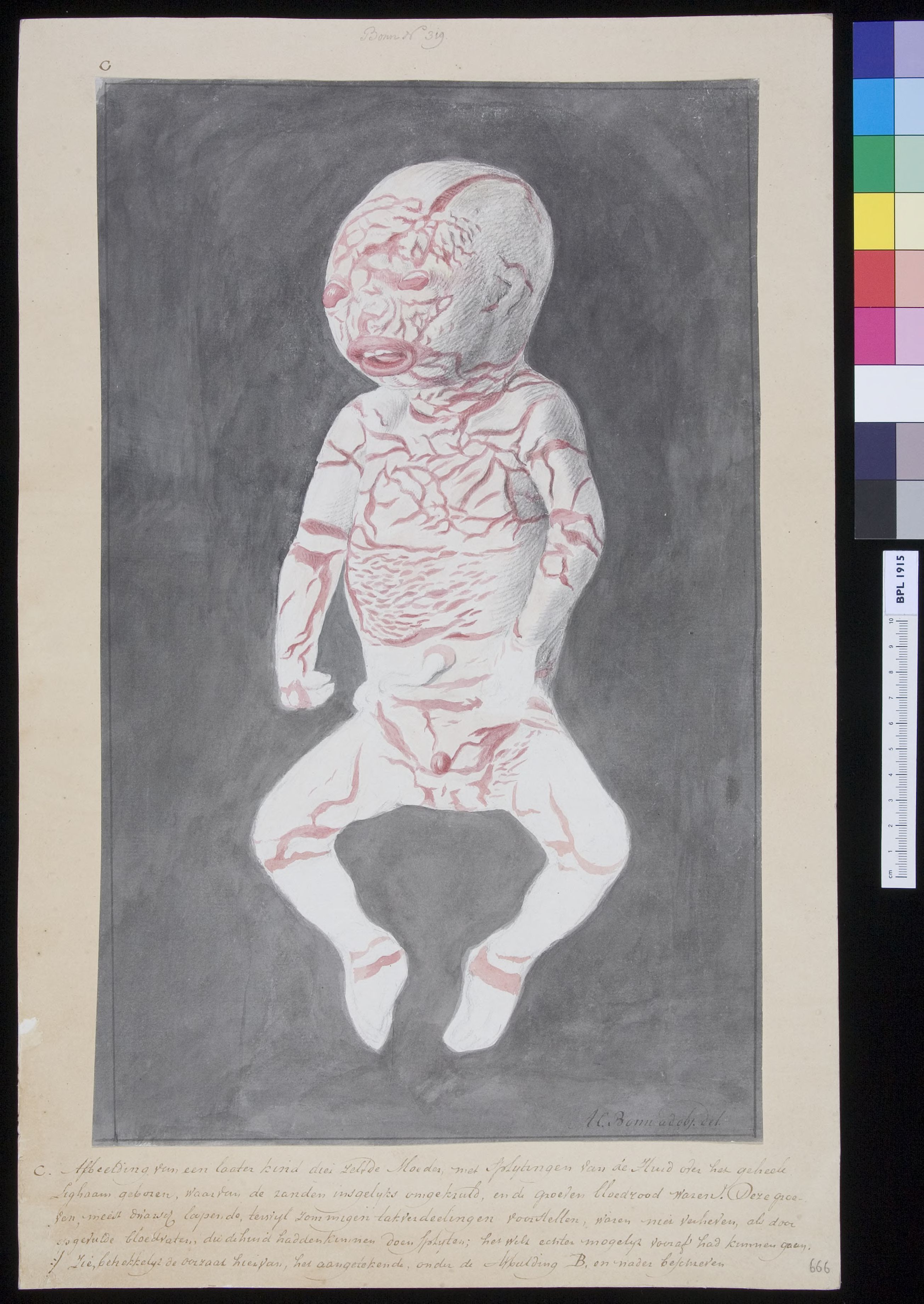 Infant with perforated skin