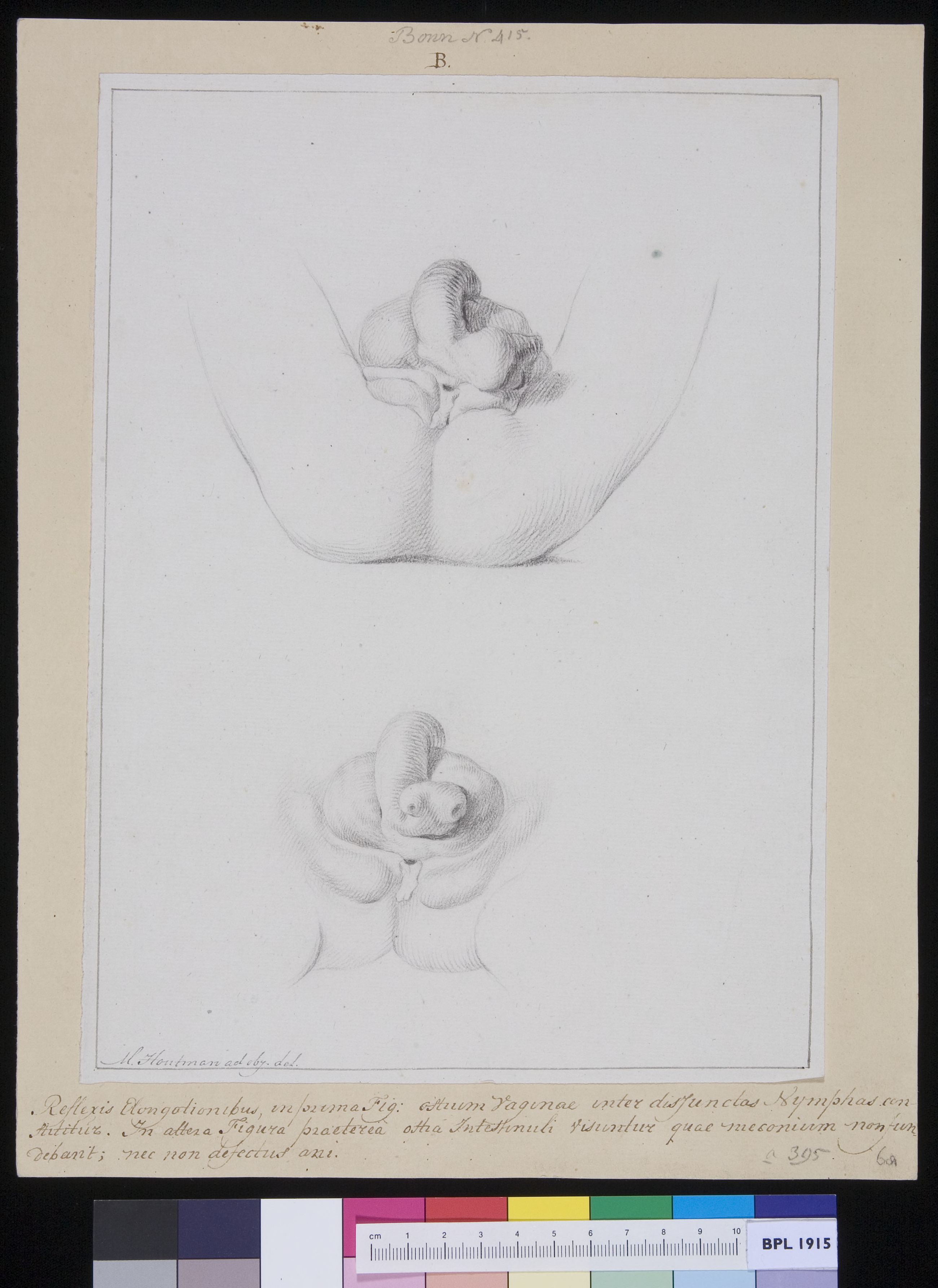 Deformed pubic area in a girl