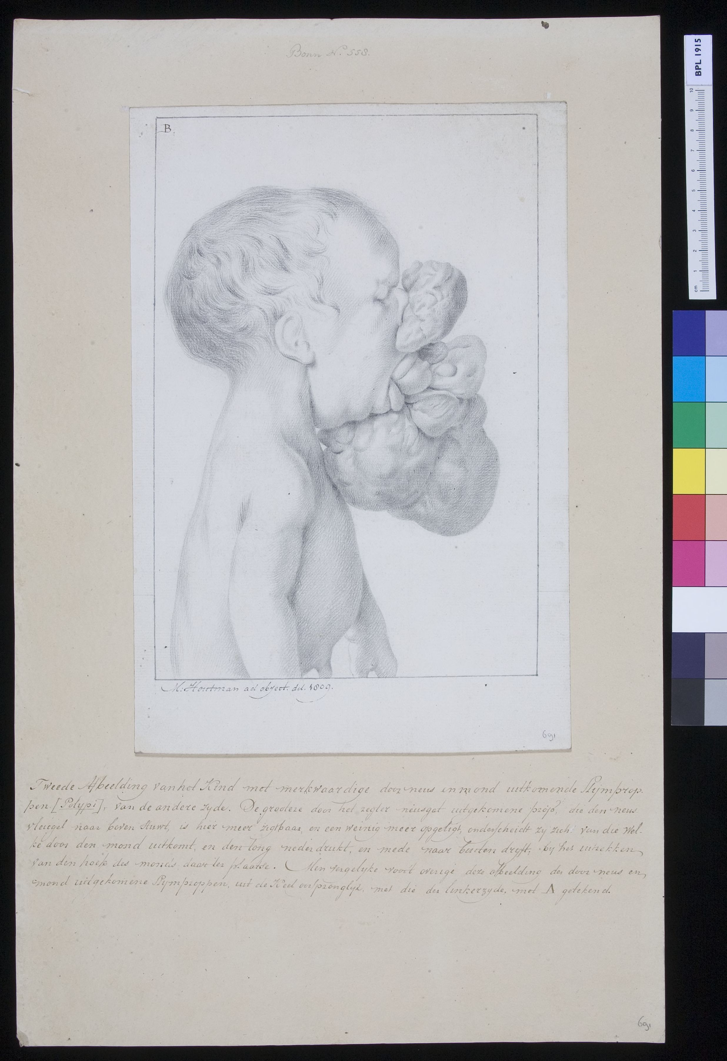 Child with tumor through nose and mouth