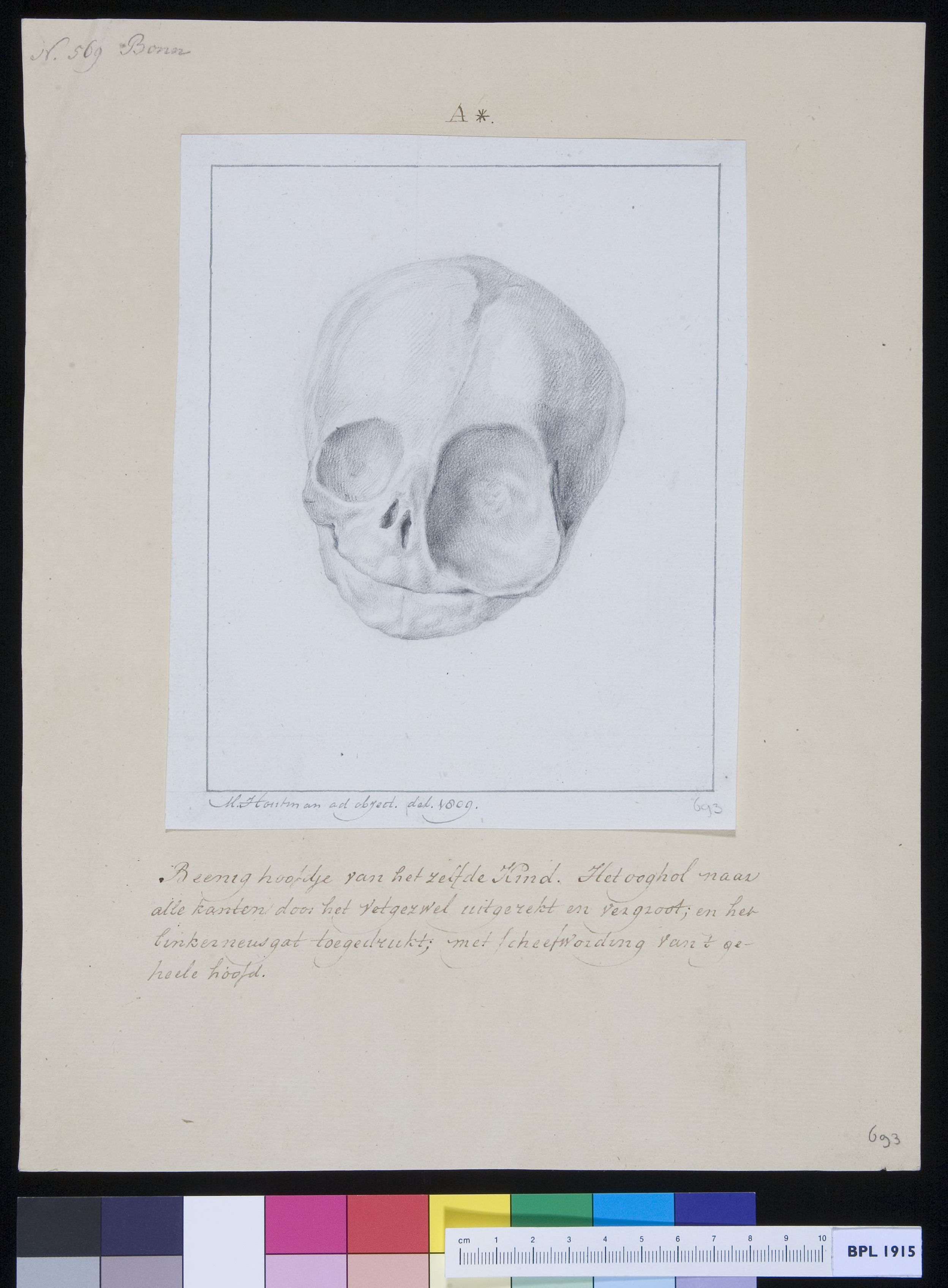 Skull of a child with enlarged eye socket