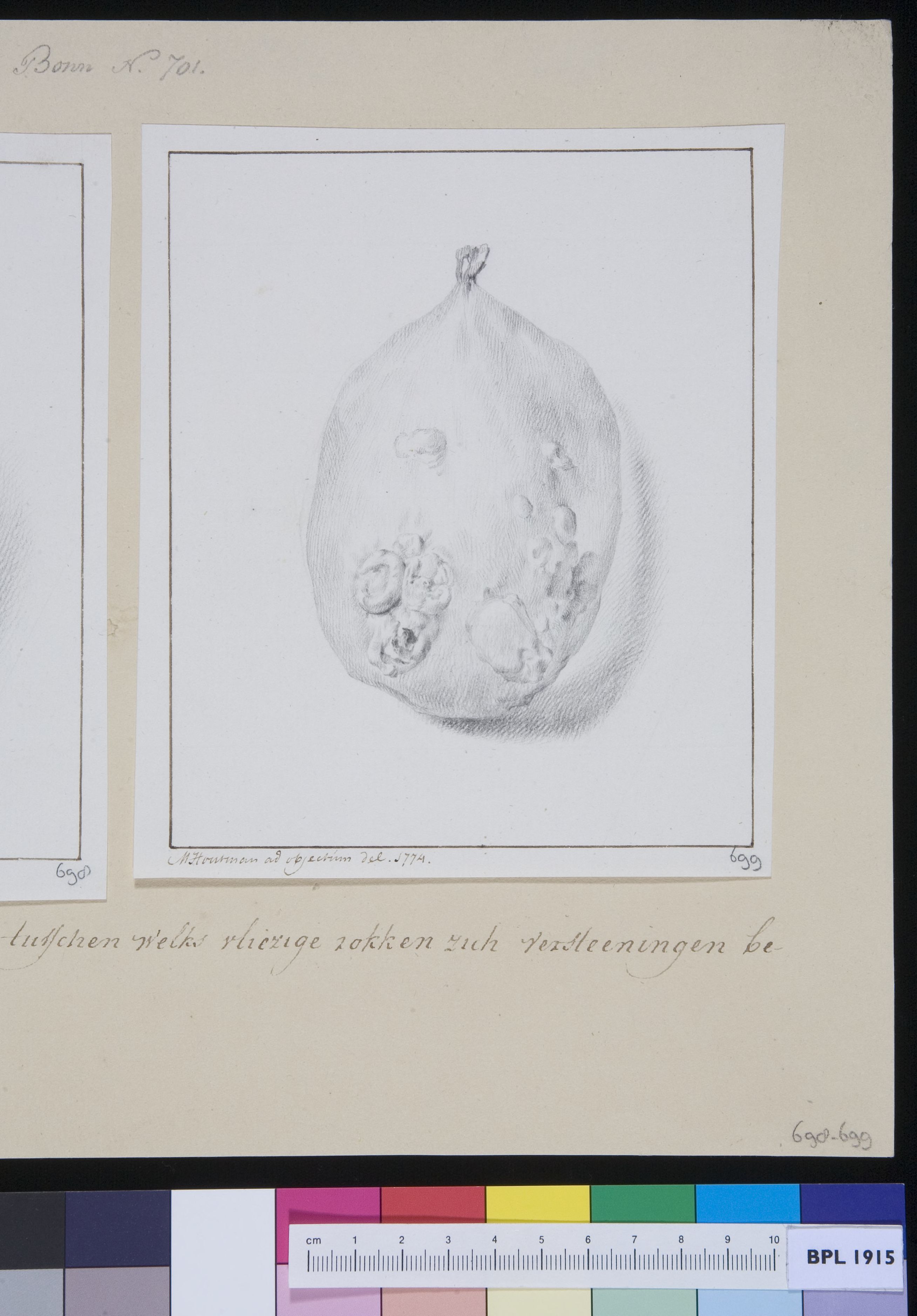 Gallbladder with stones