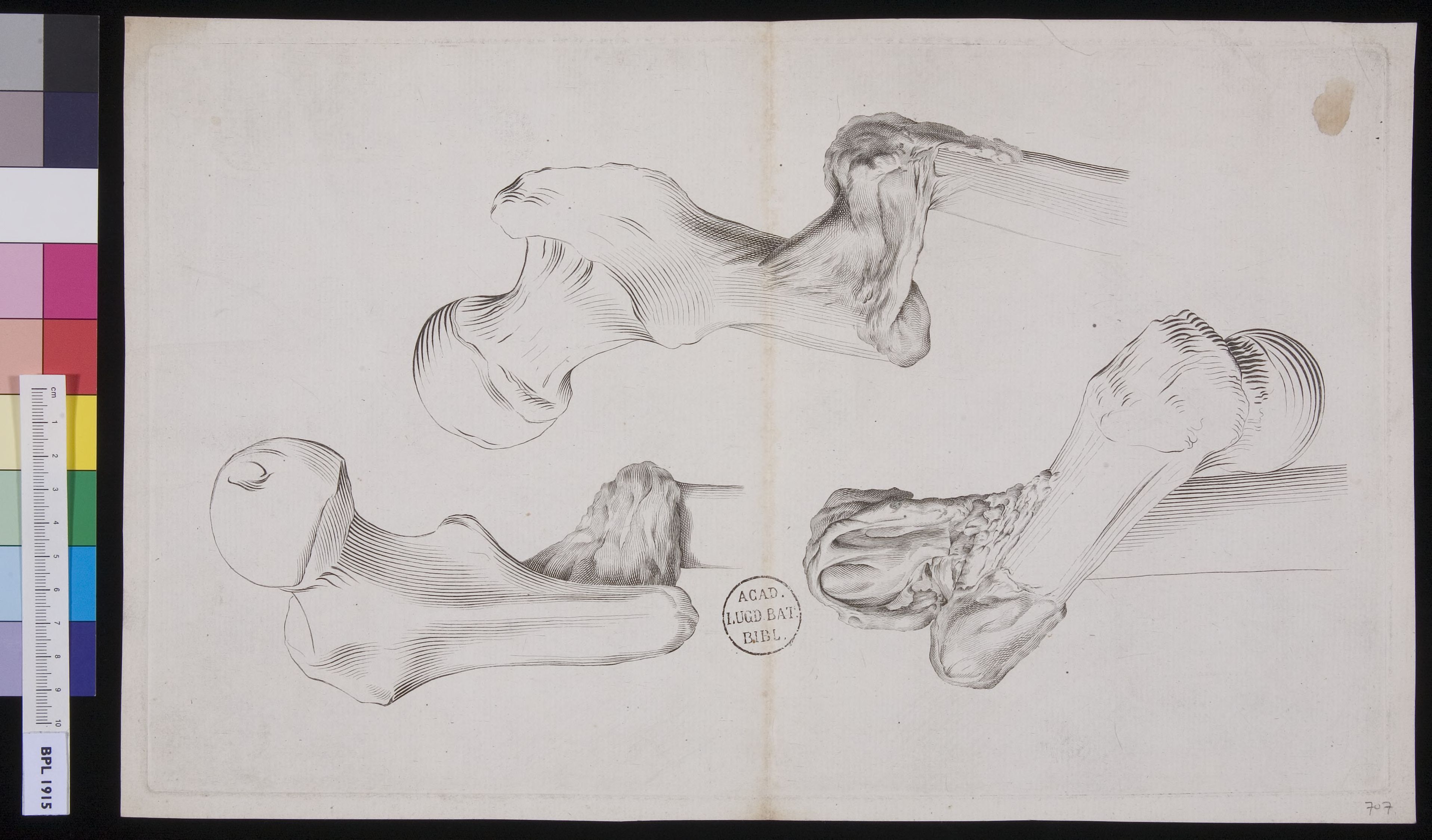 Bones from the leg: fractures