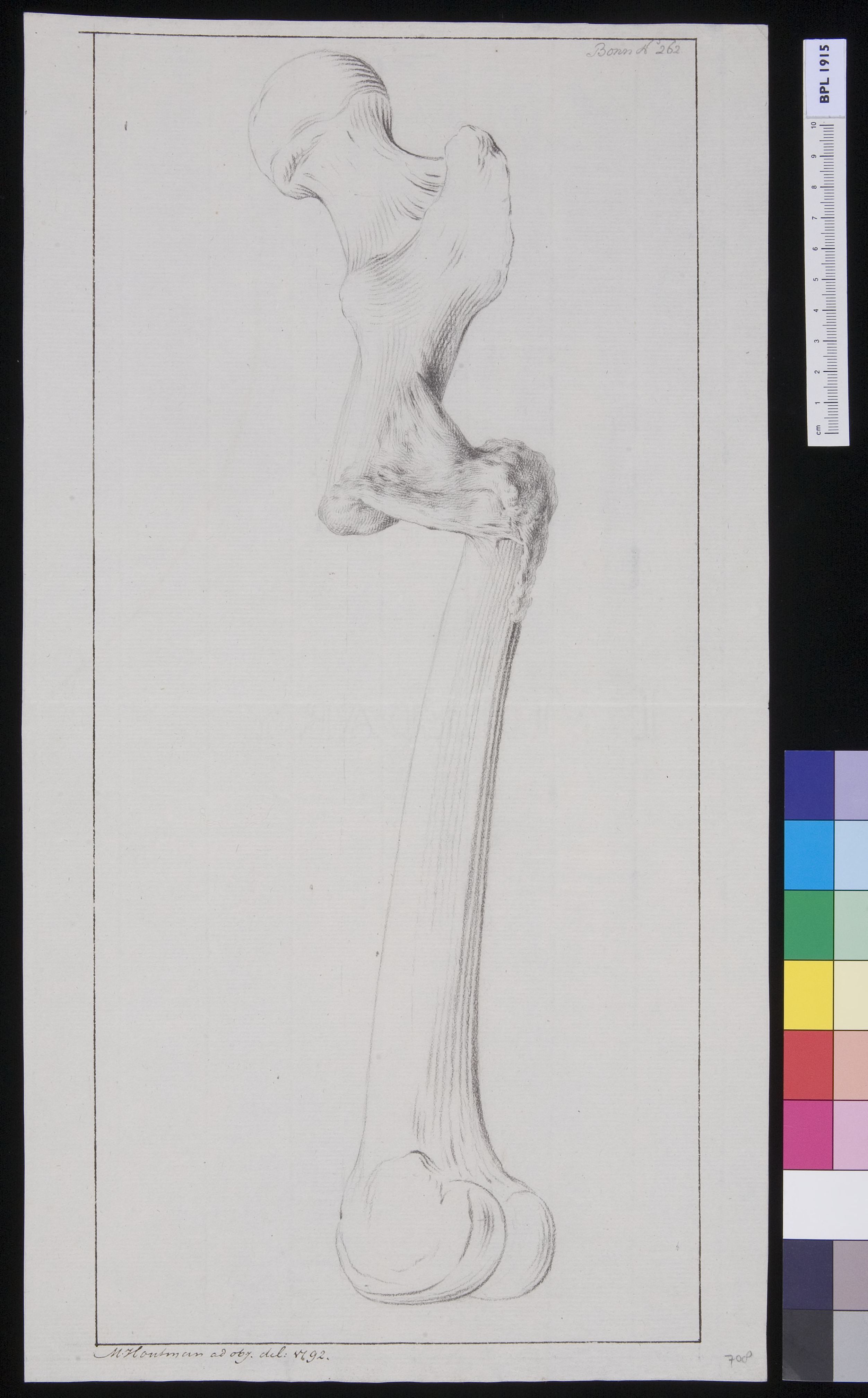 Femur: fracture