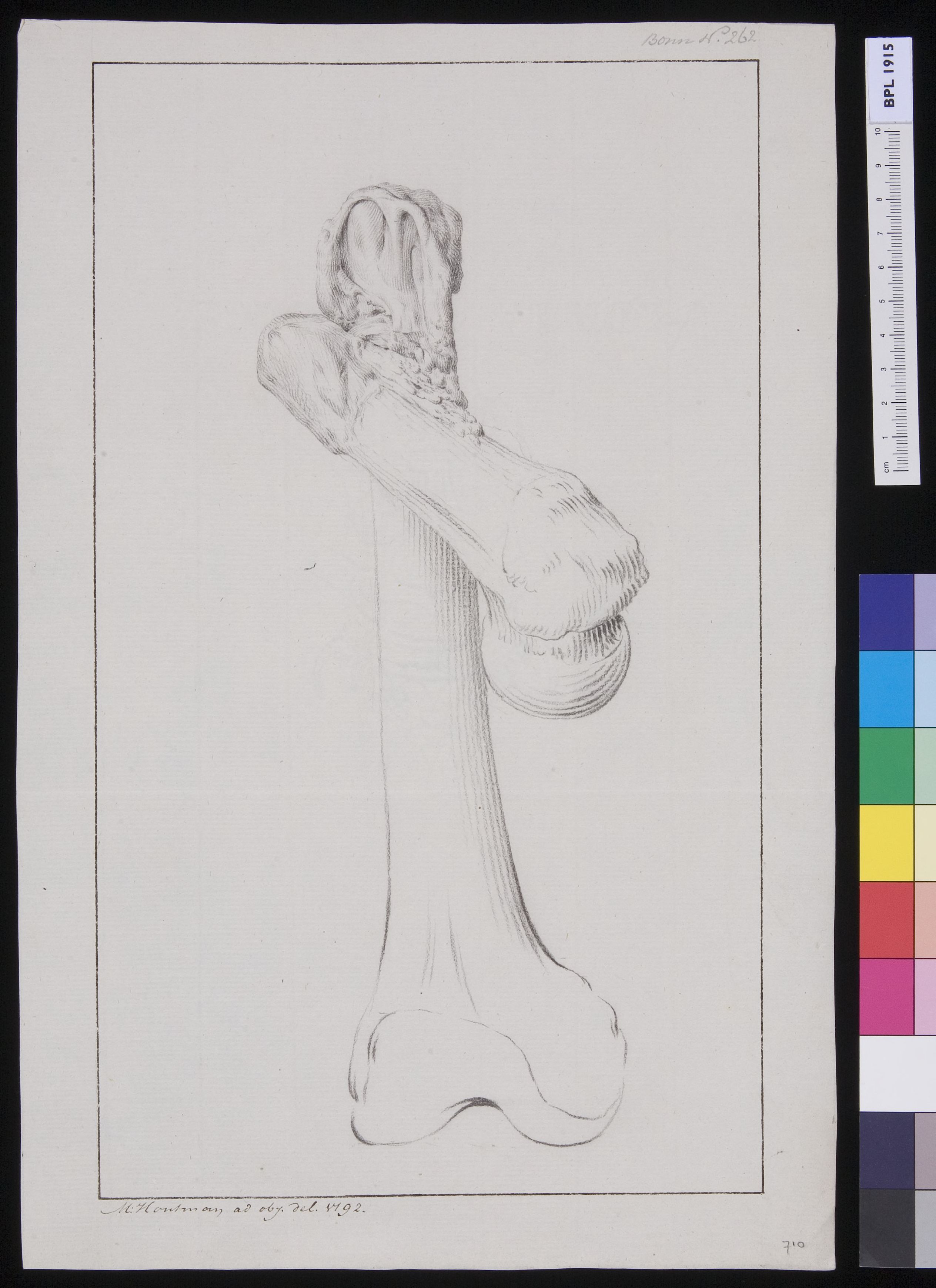 Femur: fracture