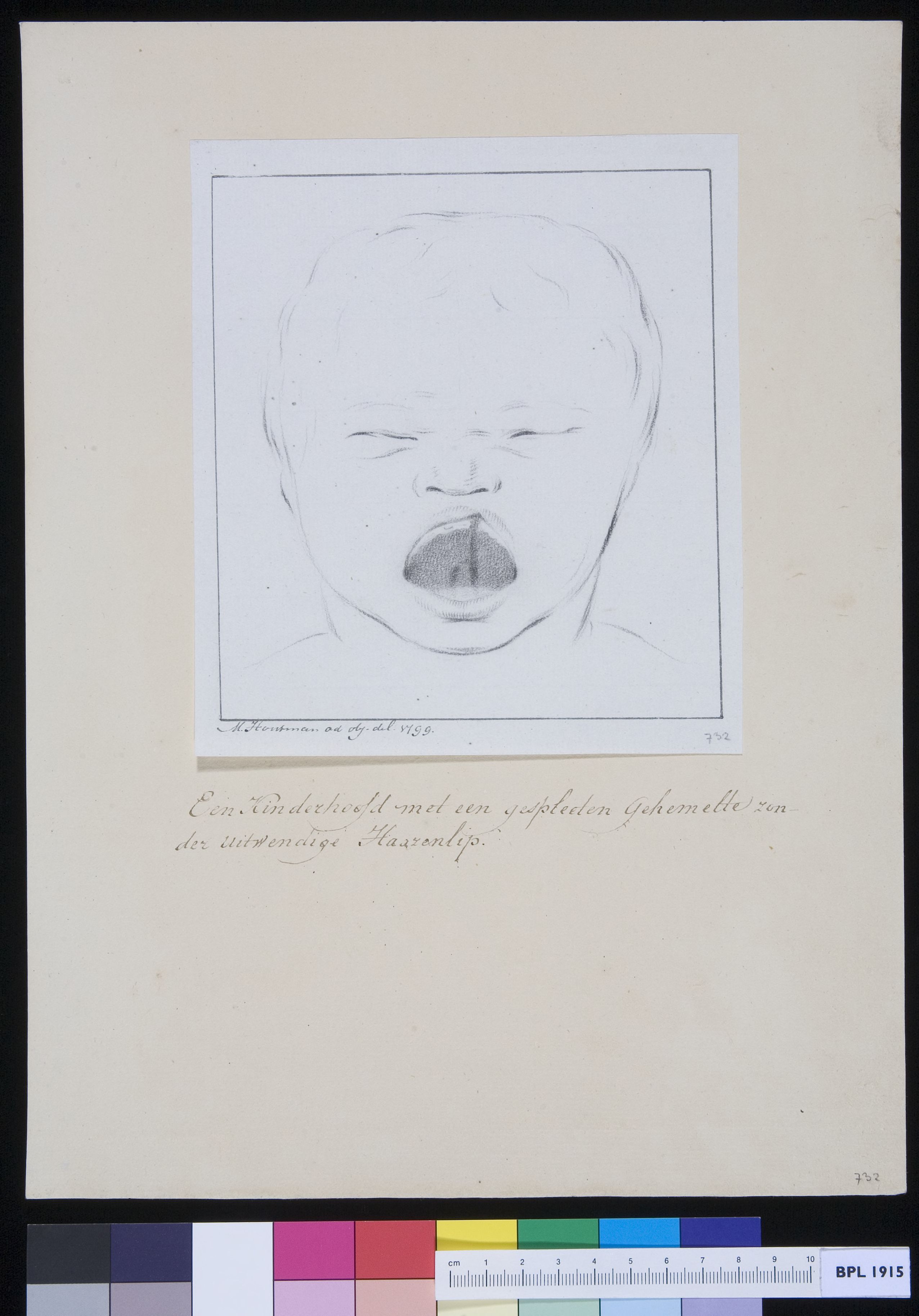 Child with cleft palate