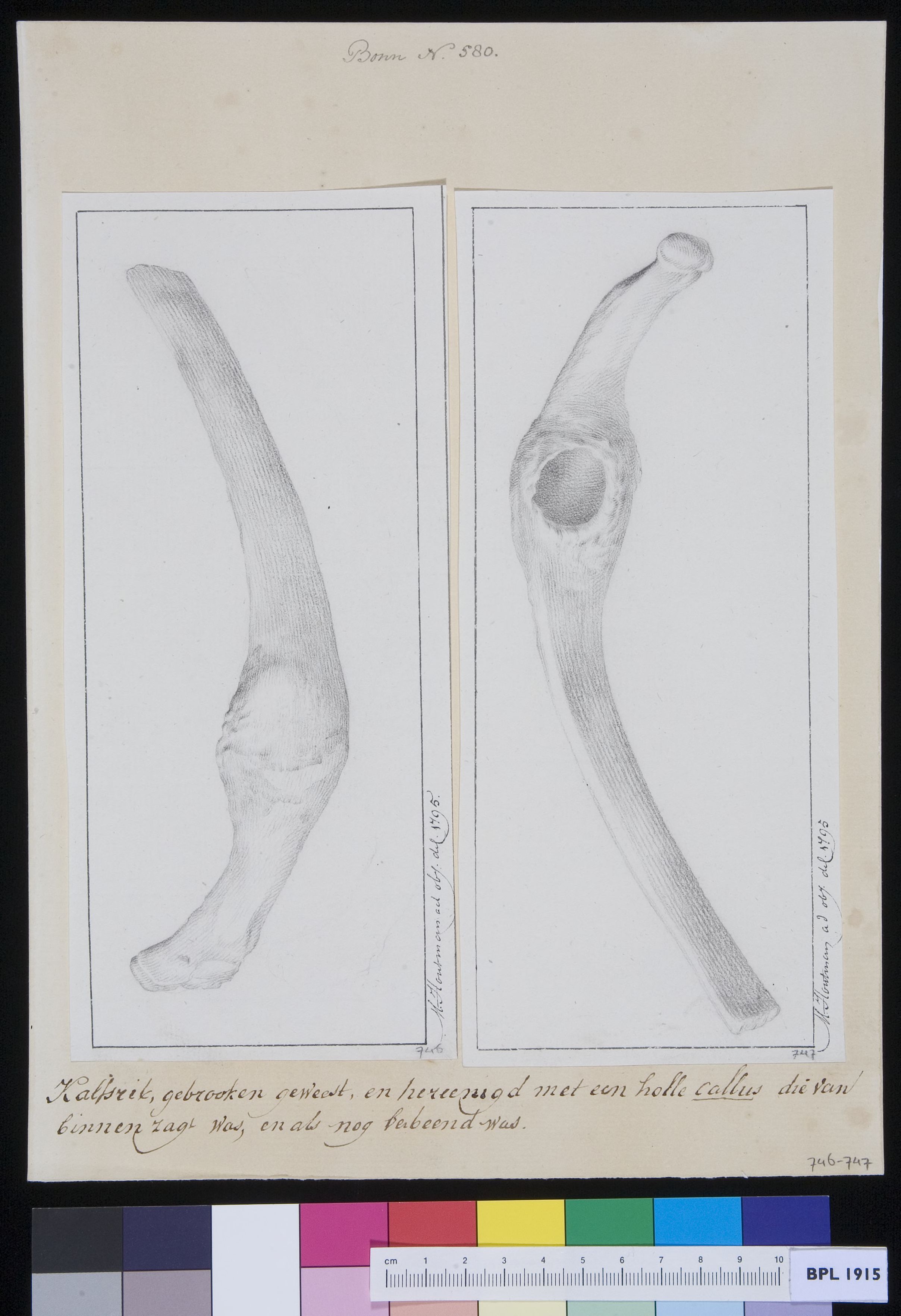 Rob of a calf: fracture