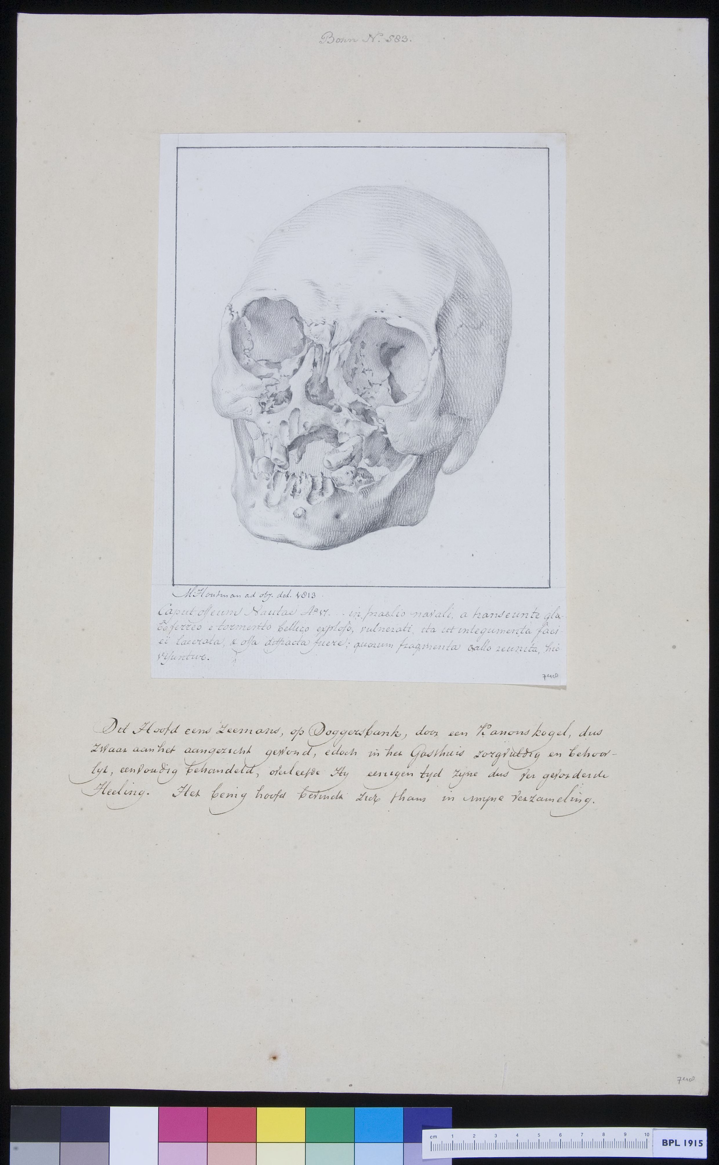 Skull of a man with trauma
