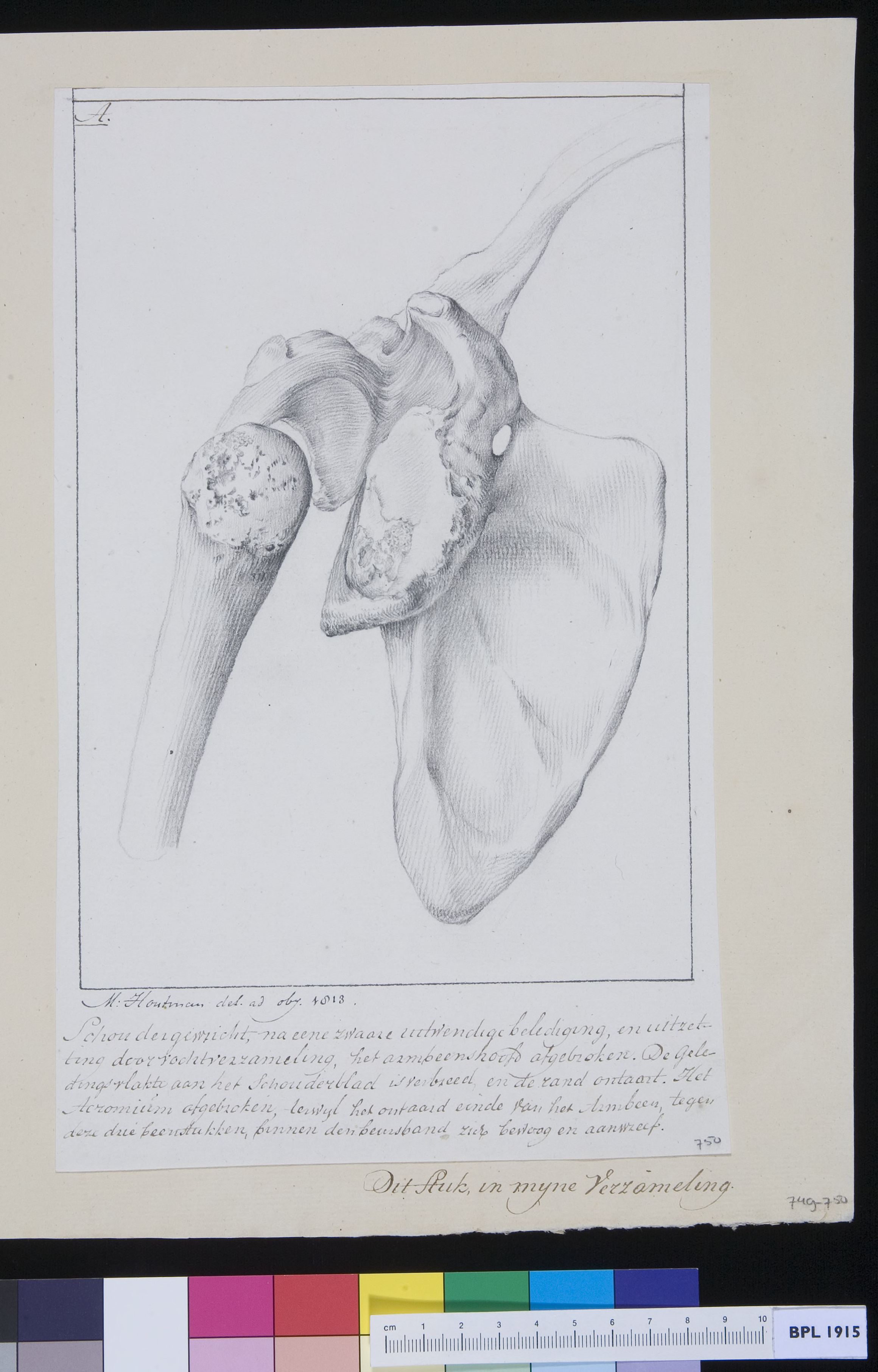 Shoulder bones: fracture
