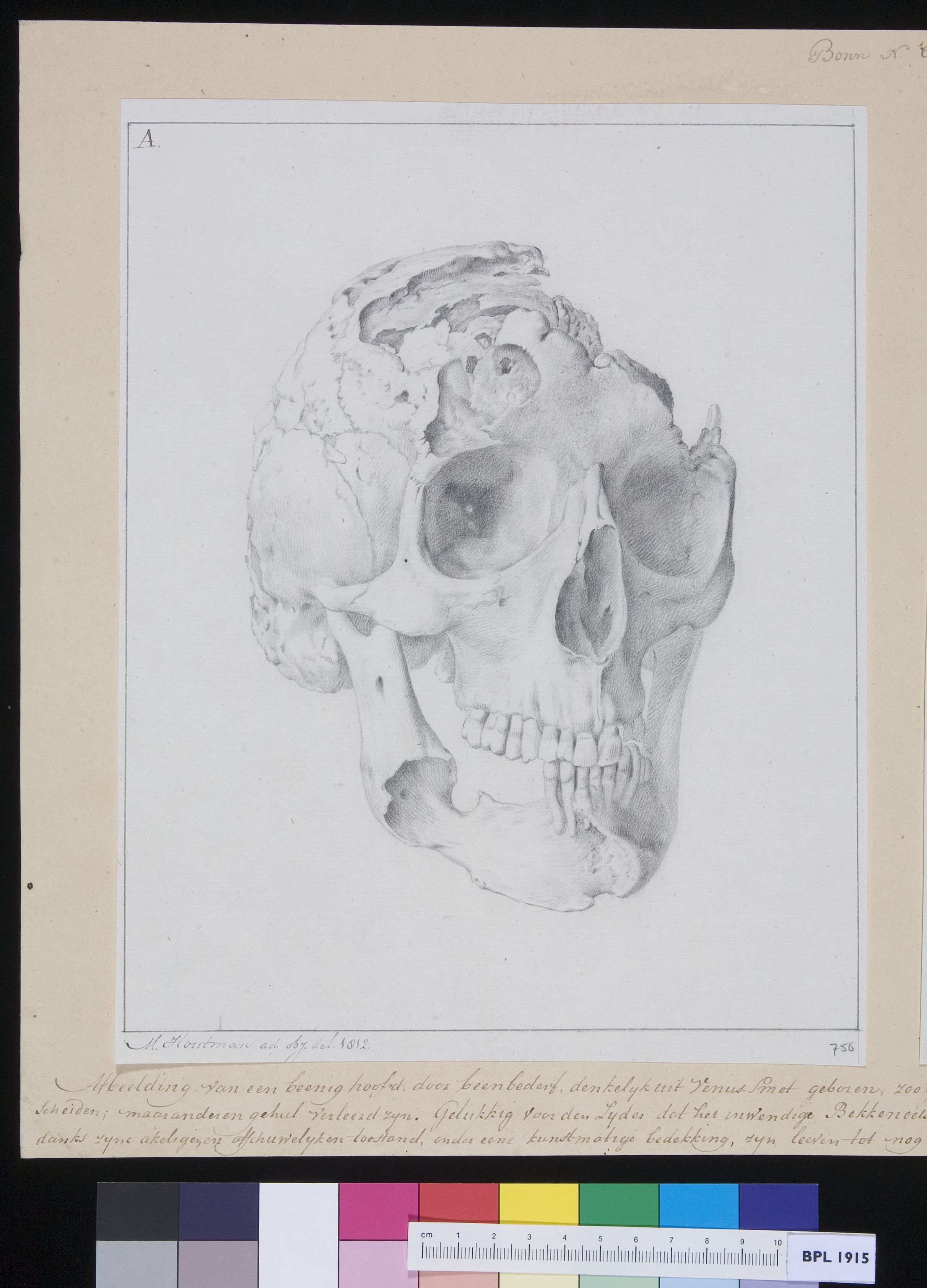 Fractured skull