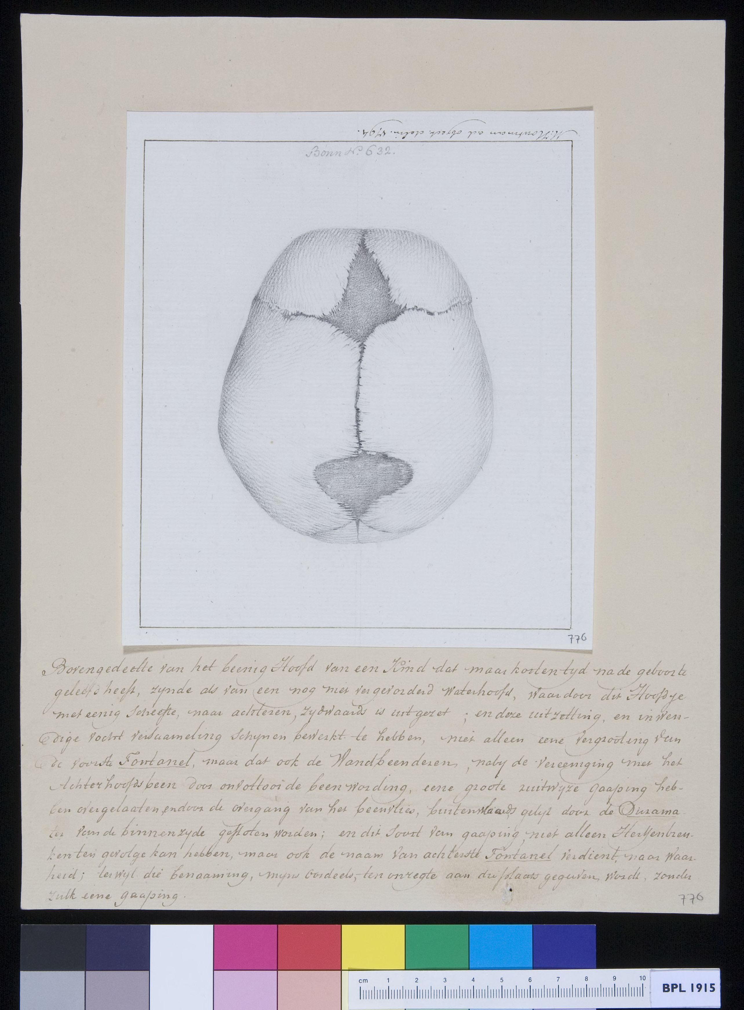 Skull of a child with hydrocephalus