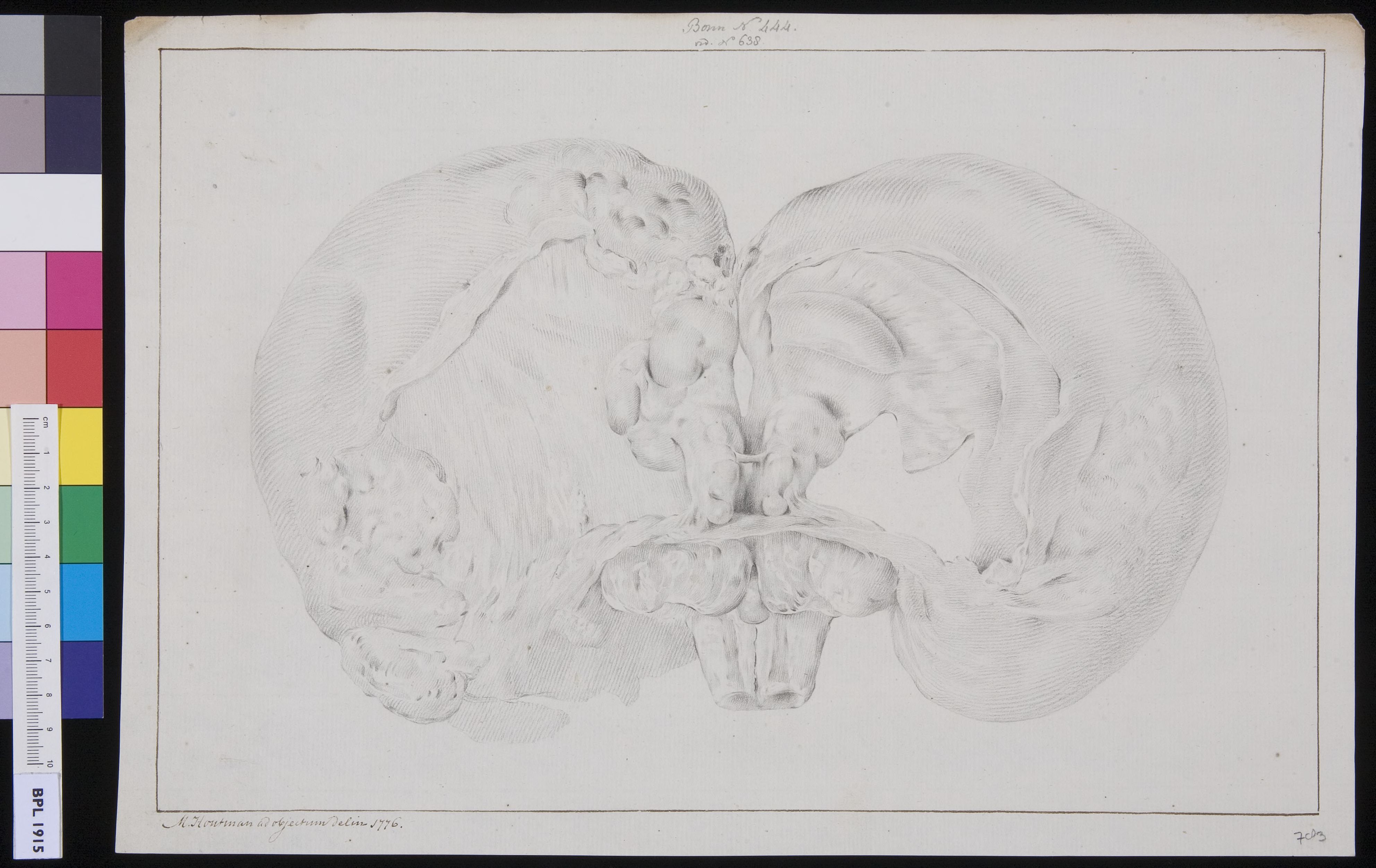 Brain of a hydrocephalic calf