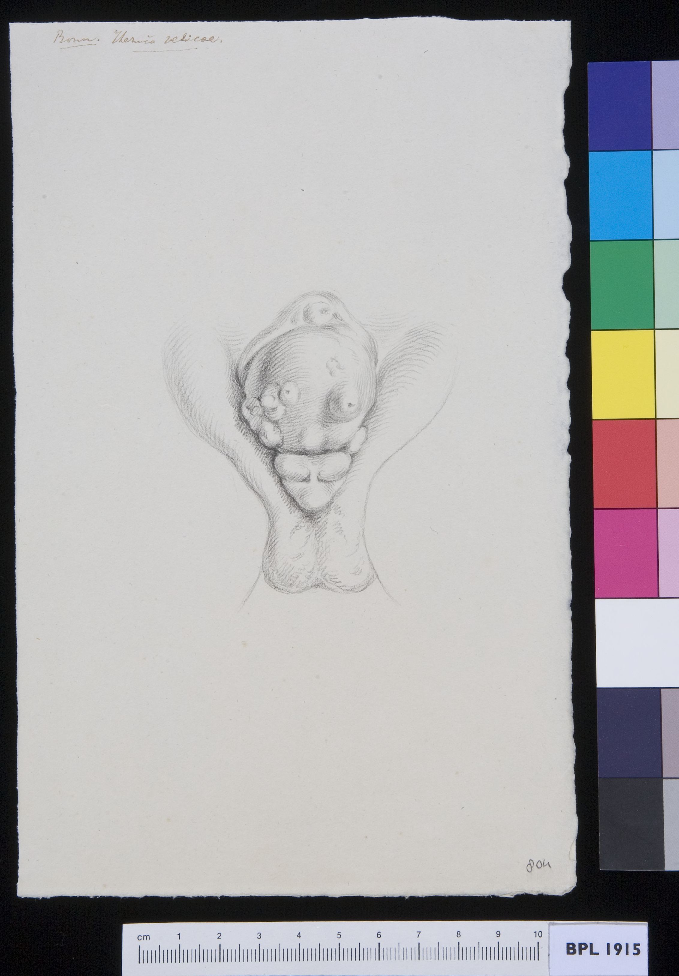 Male genitals, deformed