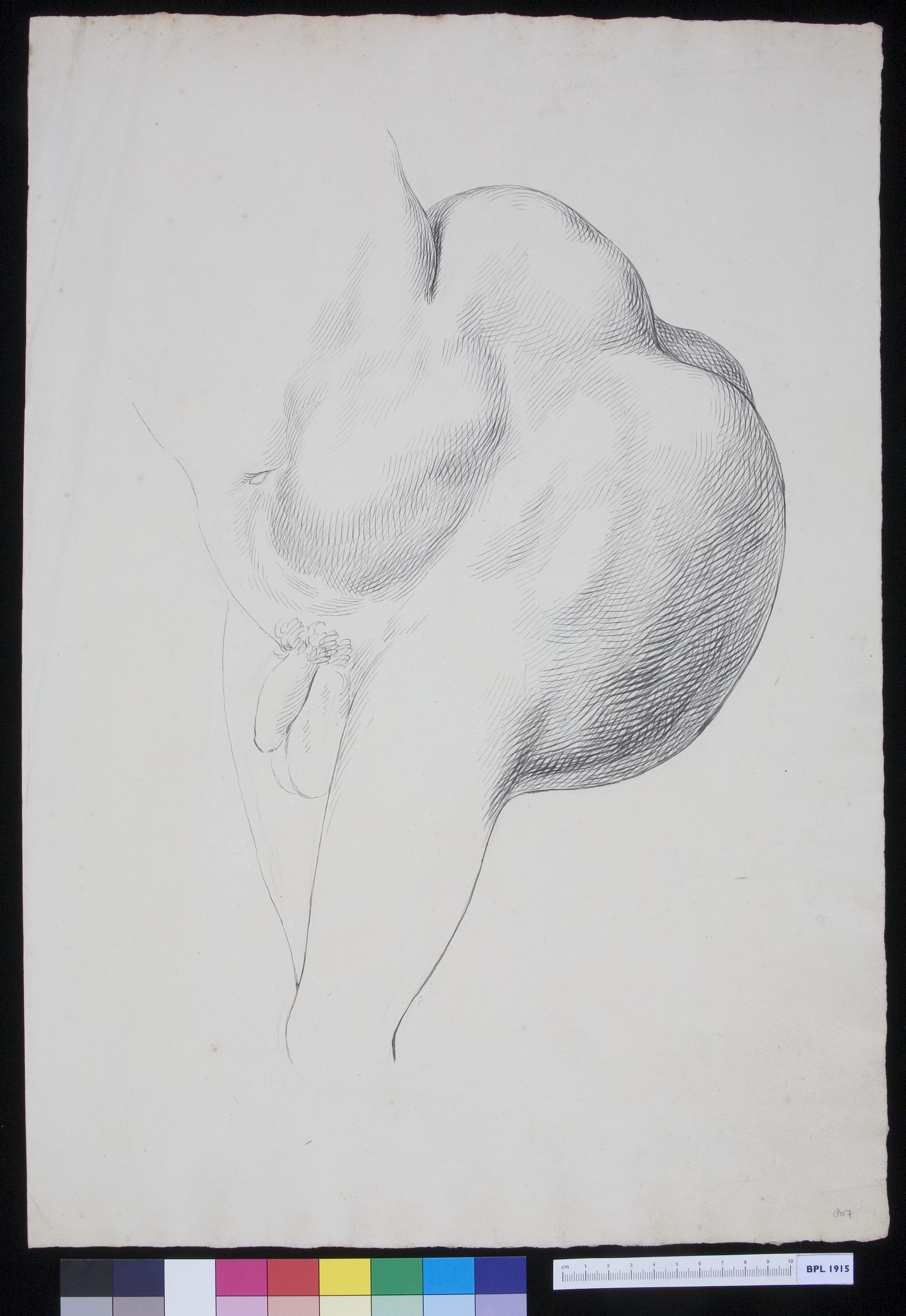 Man with a tumor growing from his buttocks