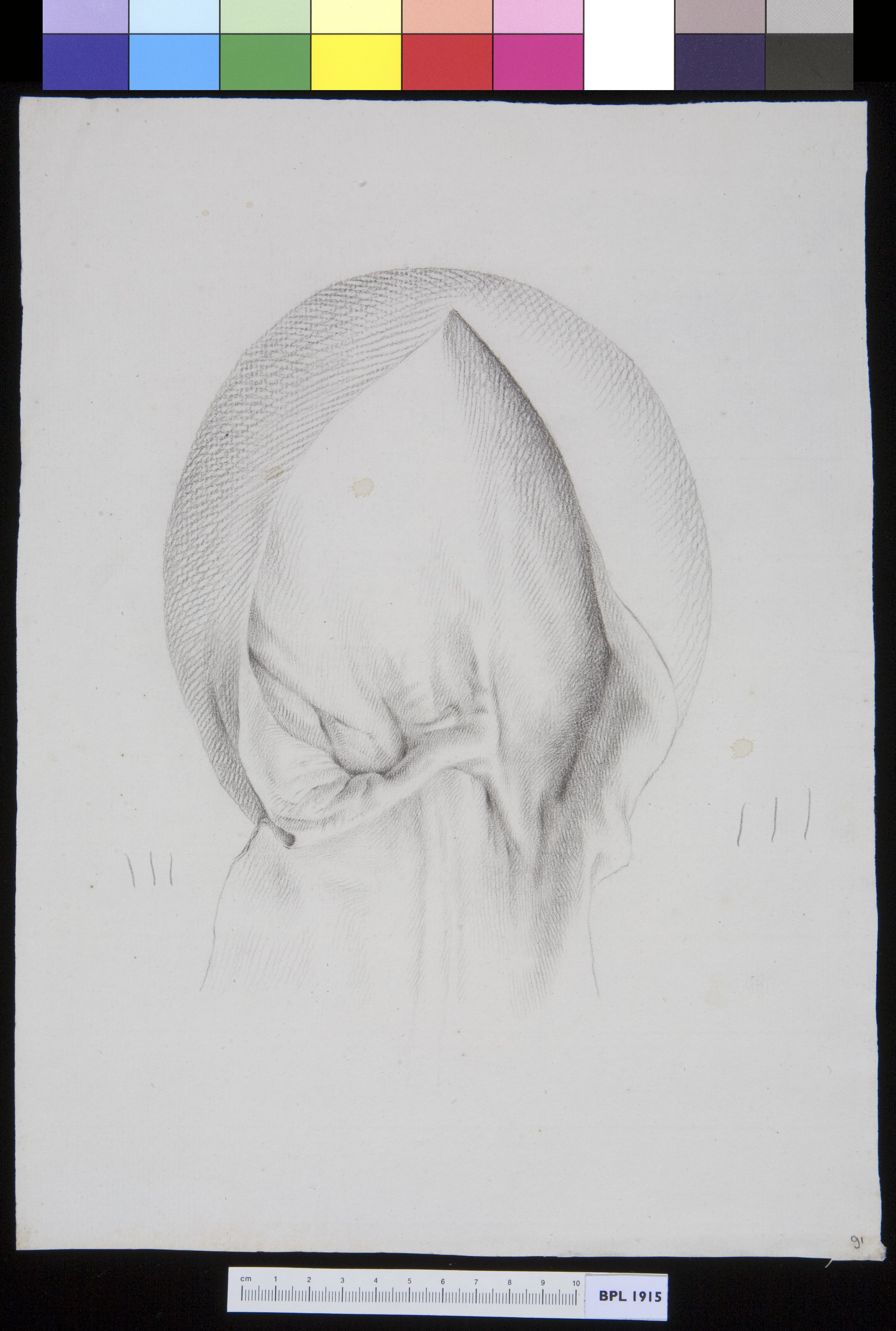 Inguinal hernia