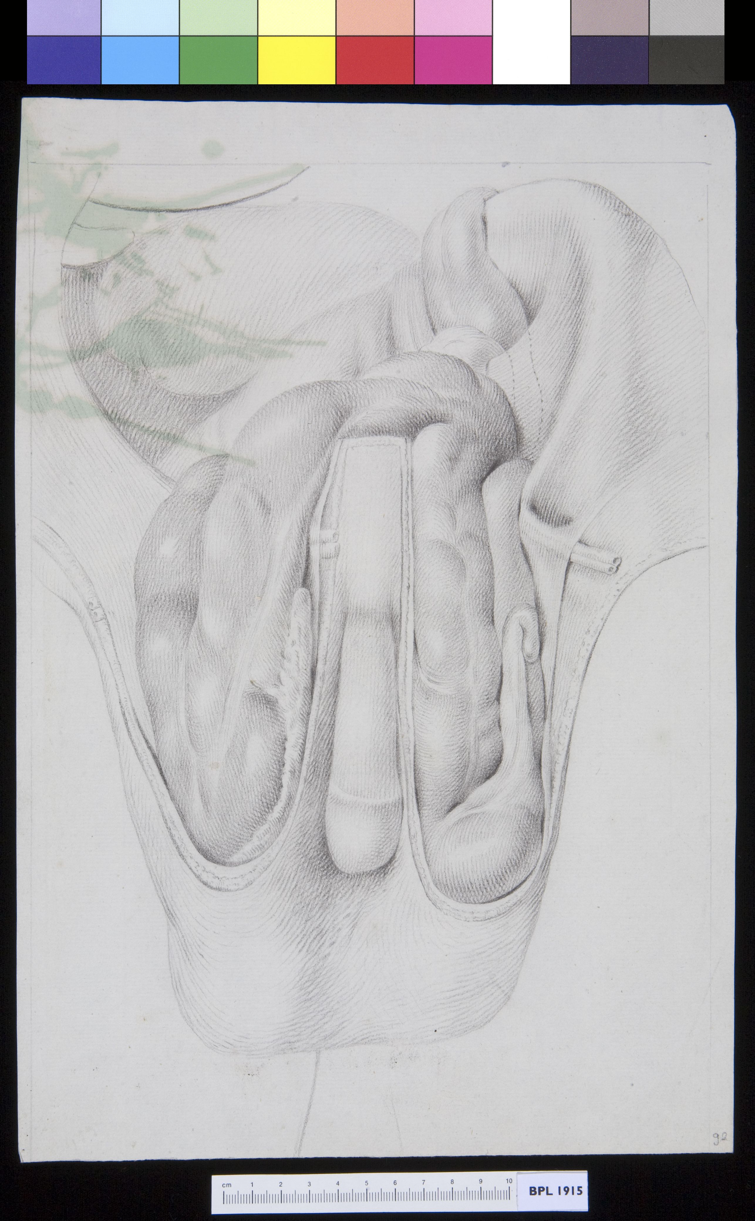 Inguinal hernia