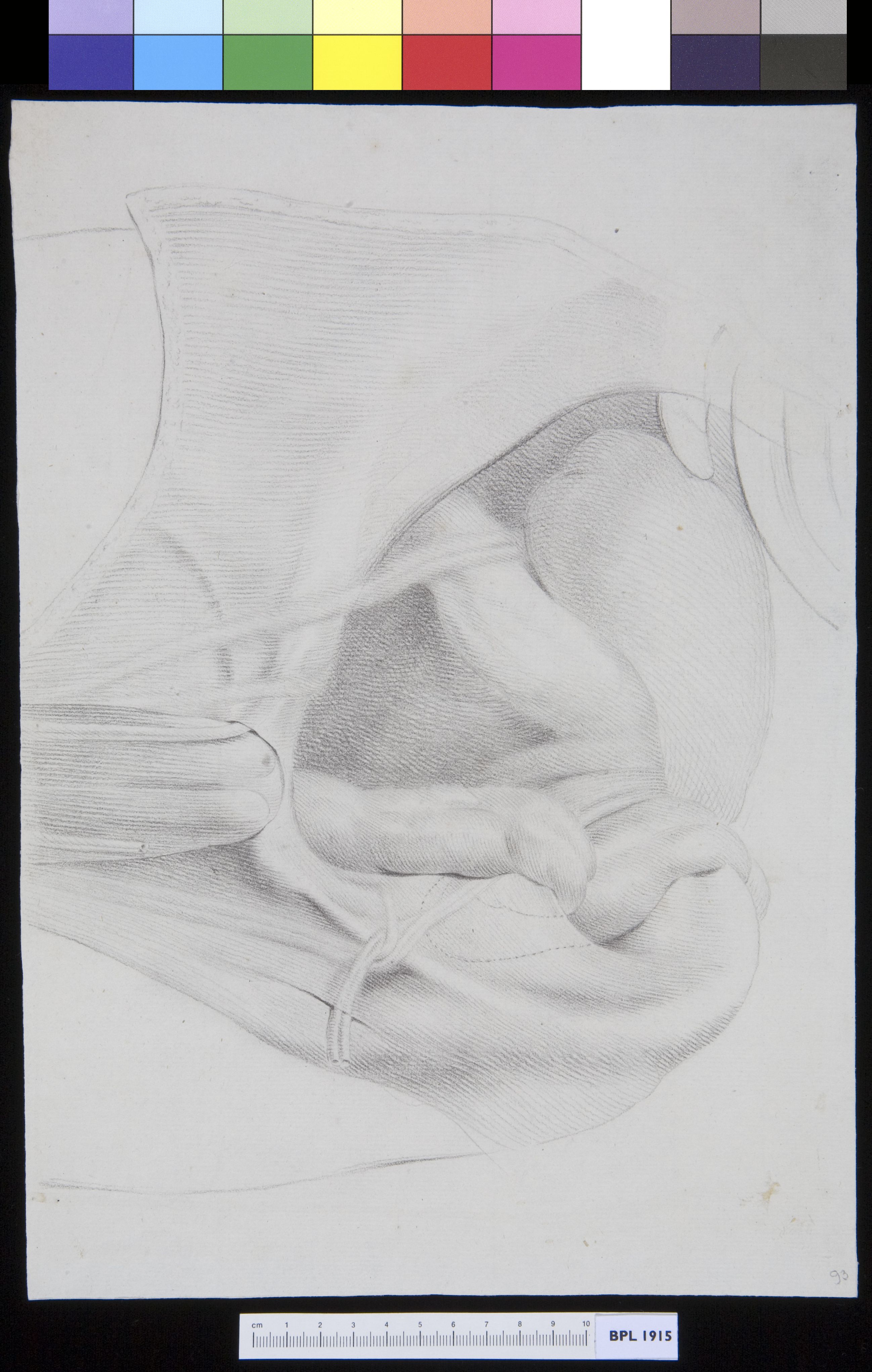 Inguinal hernia