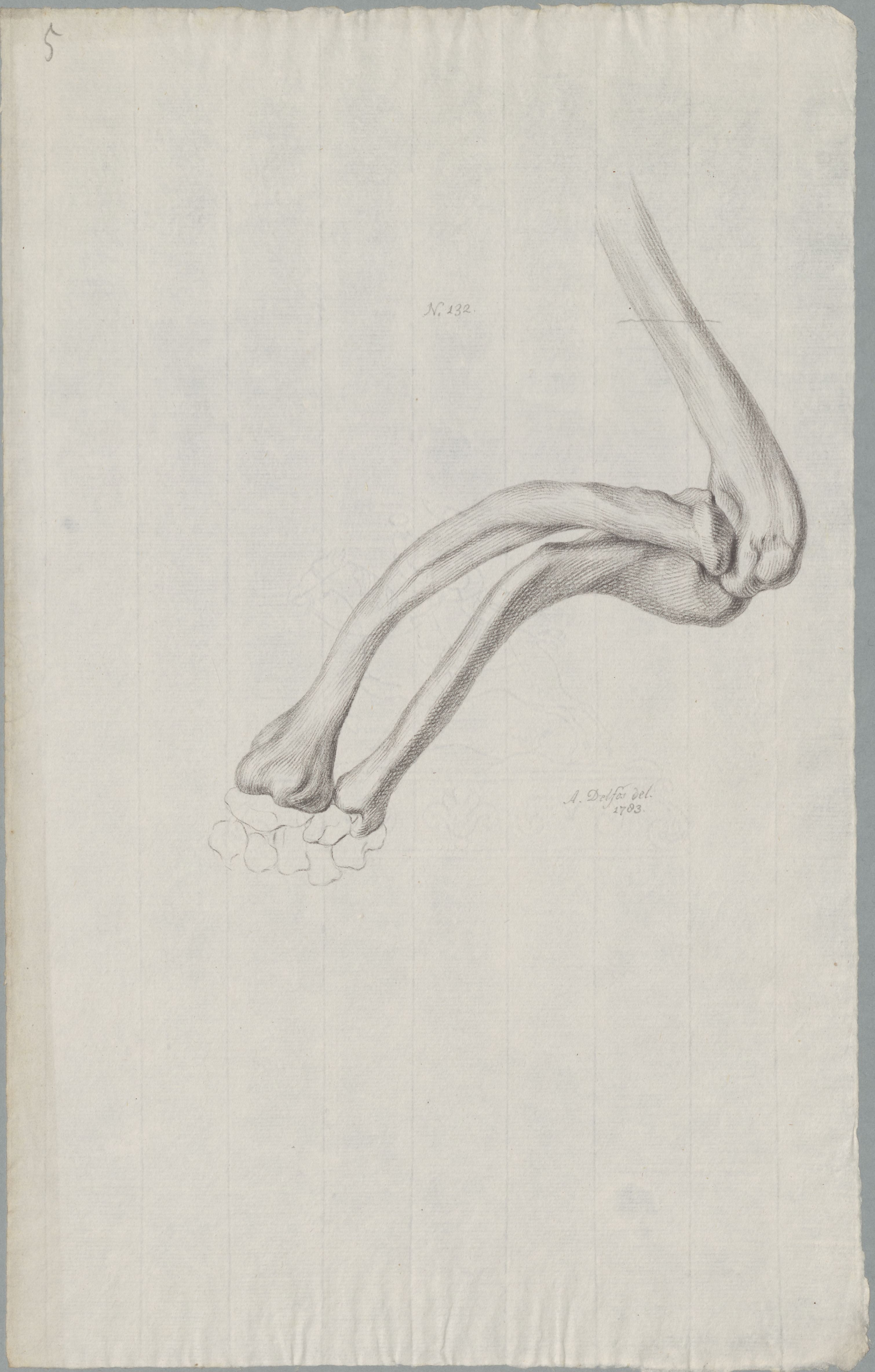 Specimens: deformed bones due to rickets