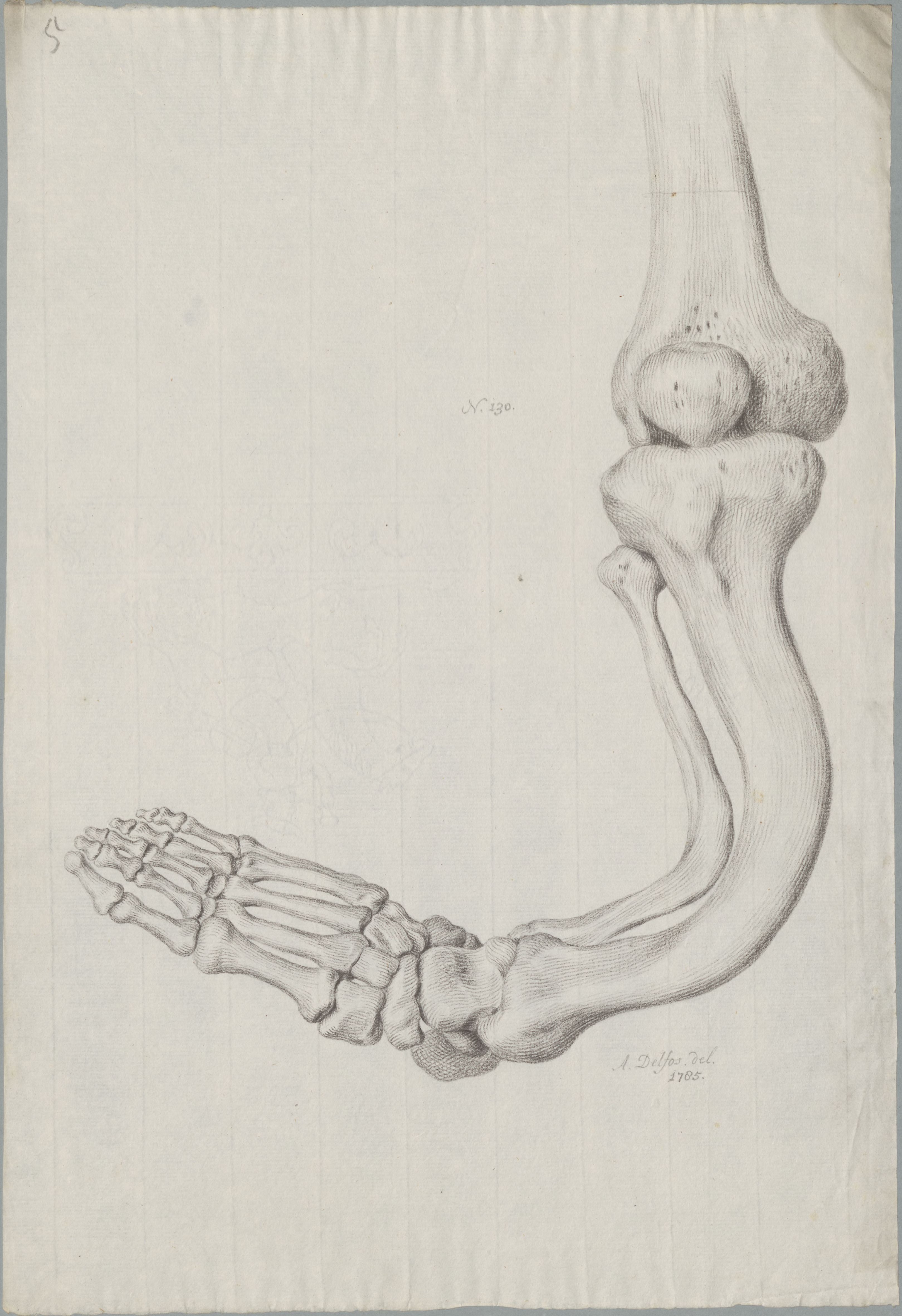 Specimens: deformed bones due to rickets