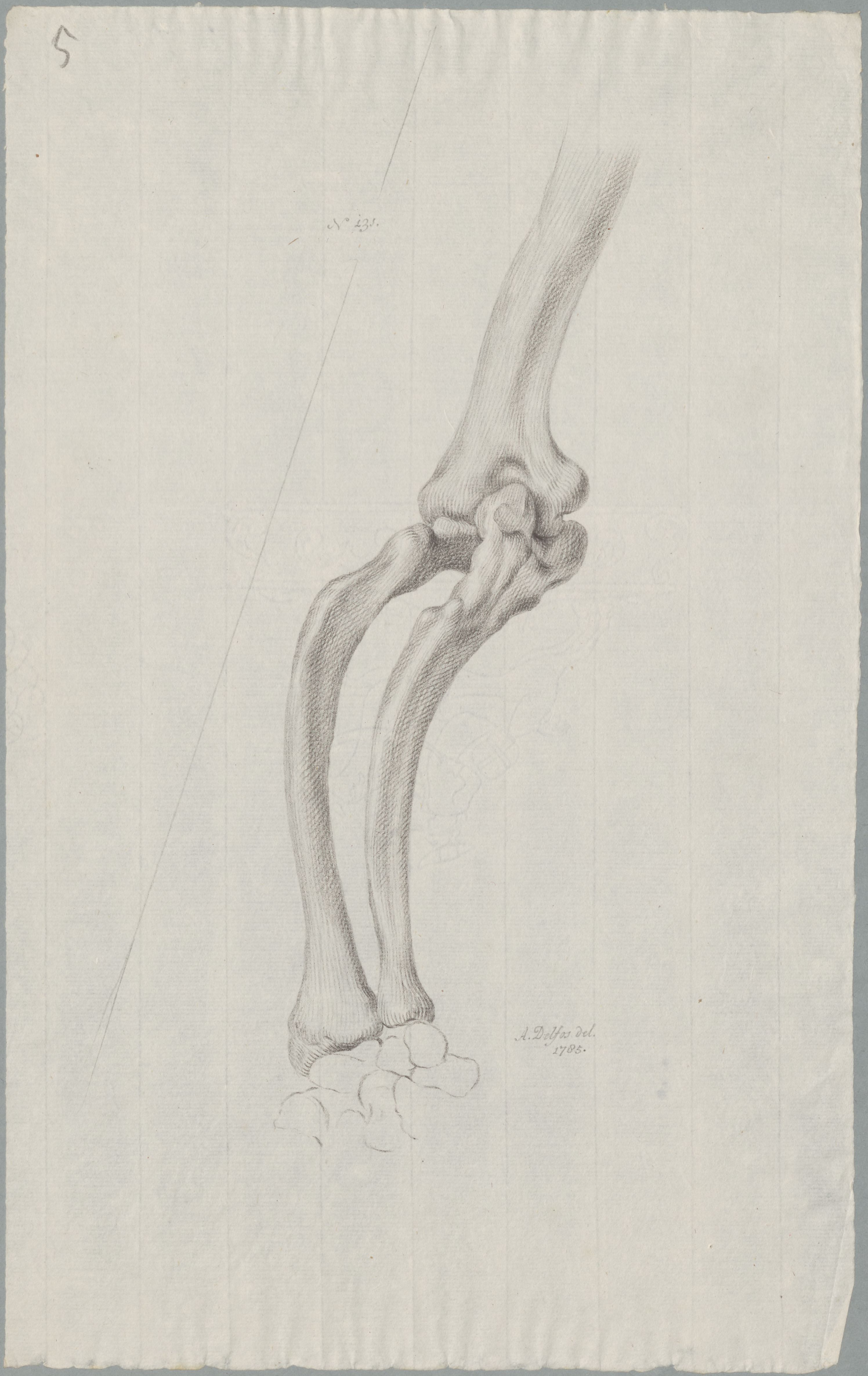 Specimens: deformed bones due to rickets