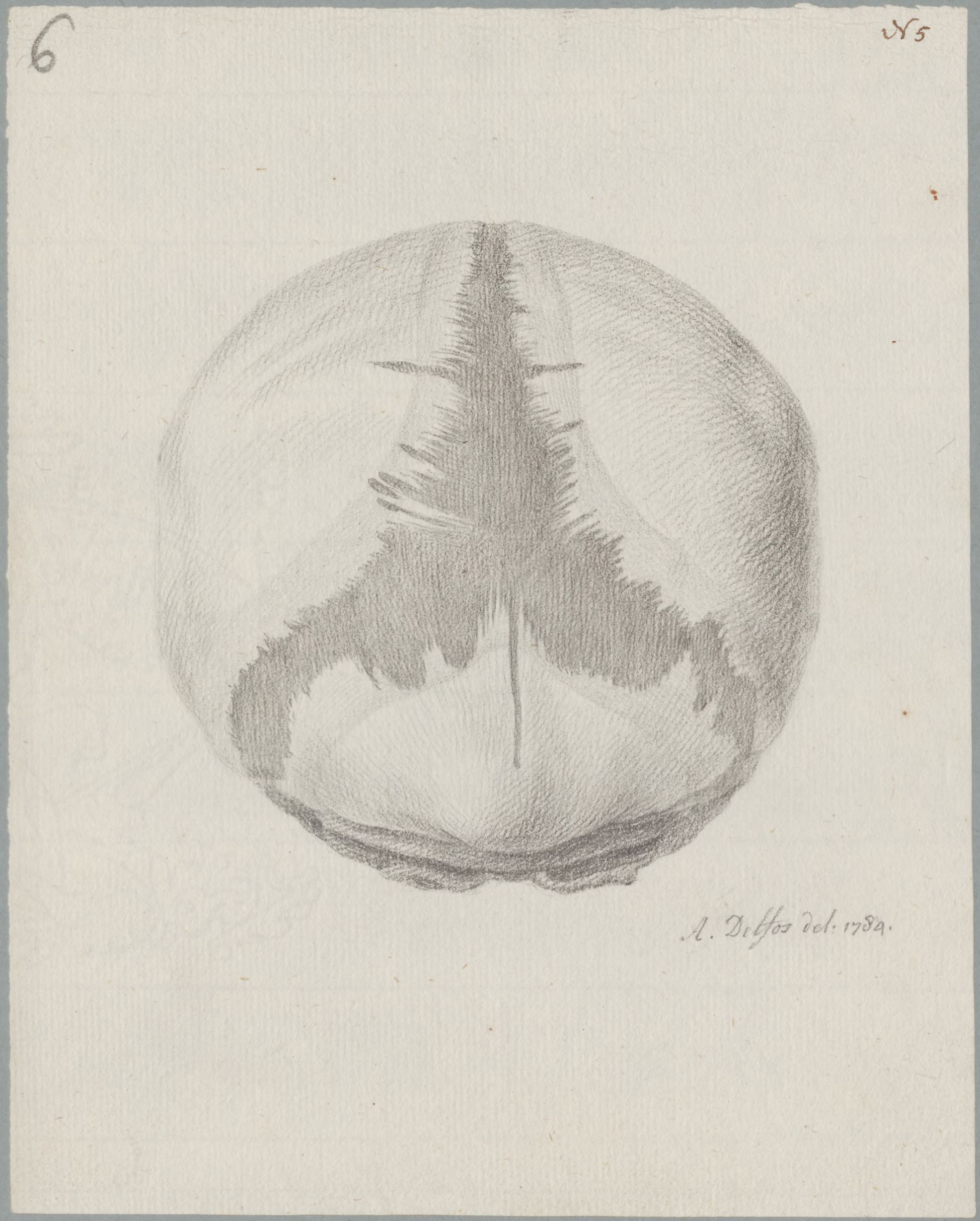 Specimens: hydrocephalus