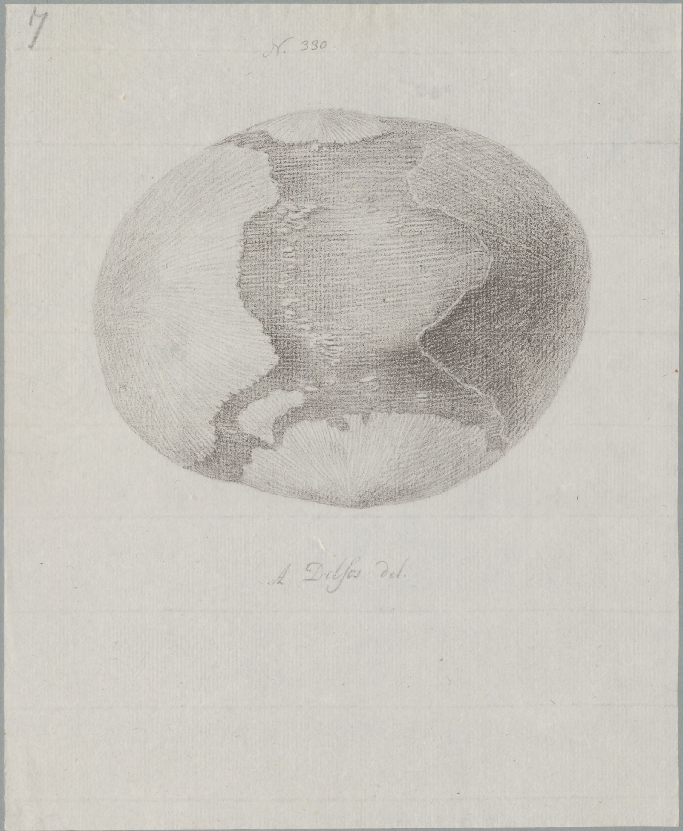 Specimens: hydrocephalus