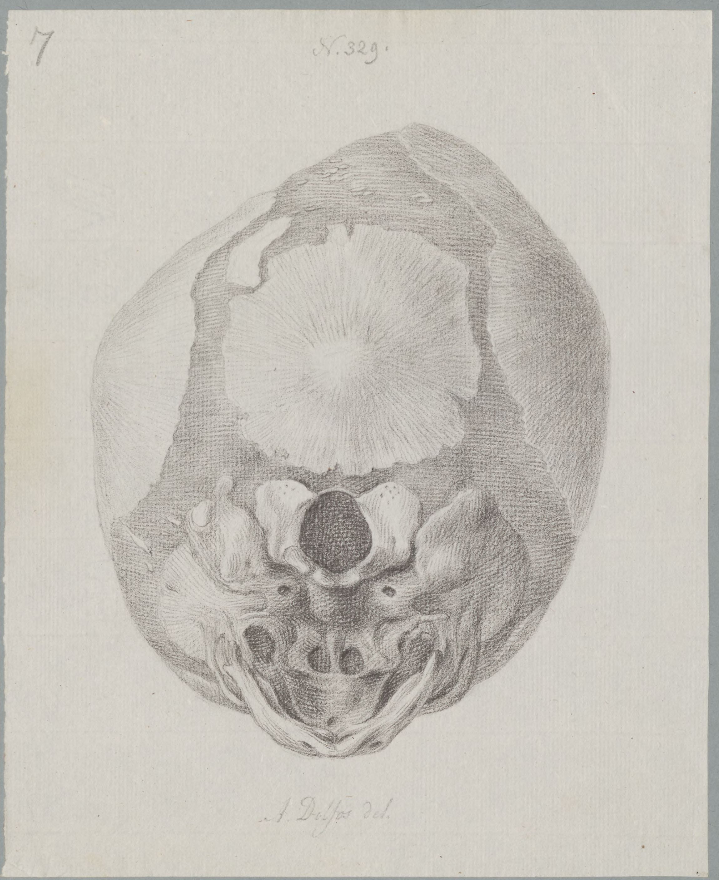 Specimens: hydrocephalus