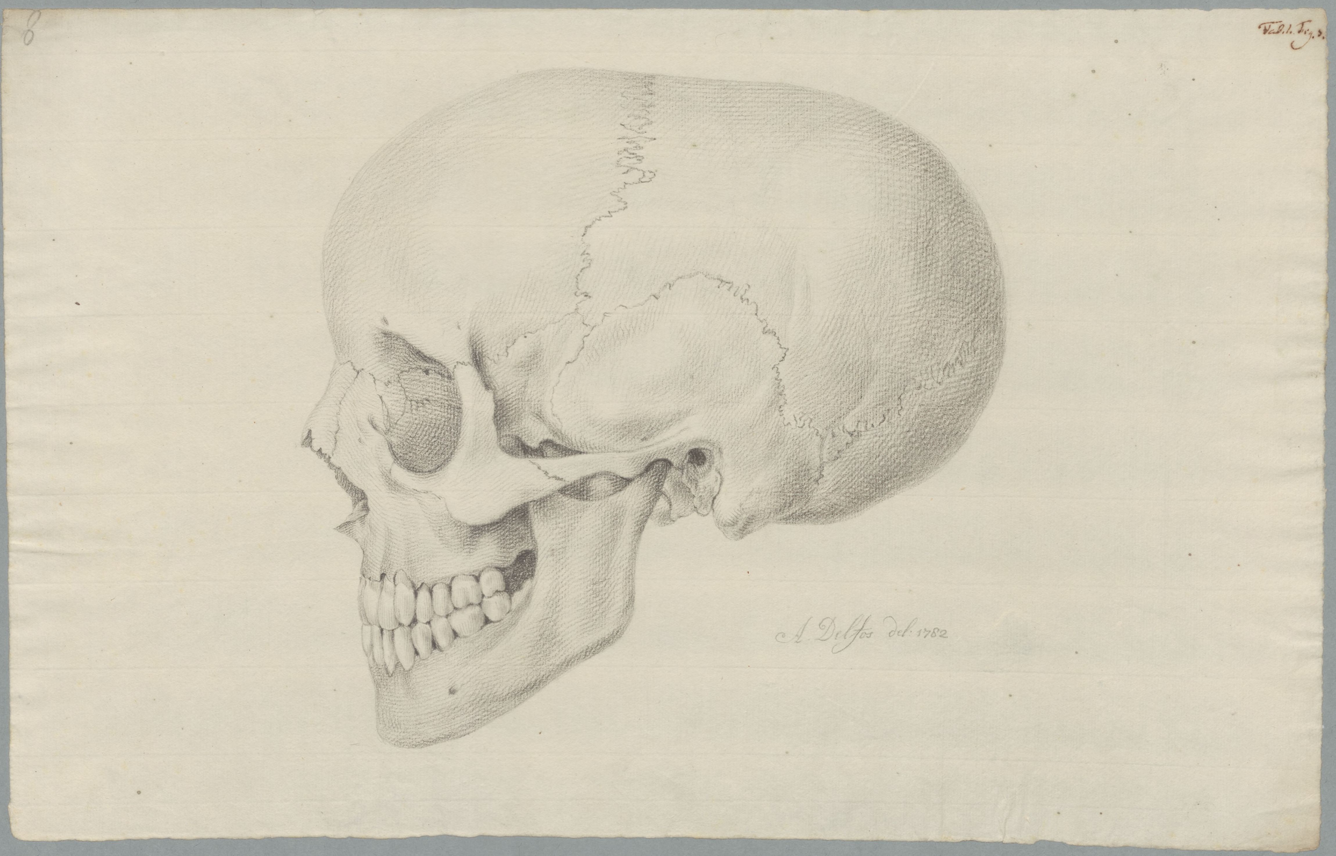 Specimens: hydrocephalus