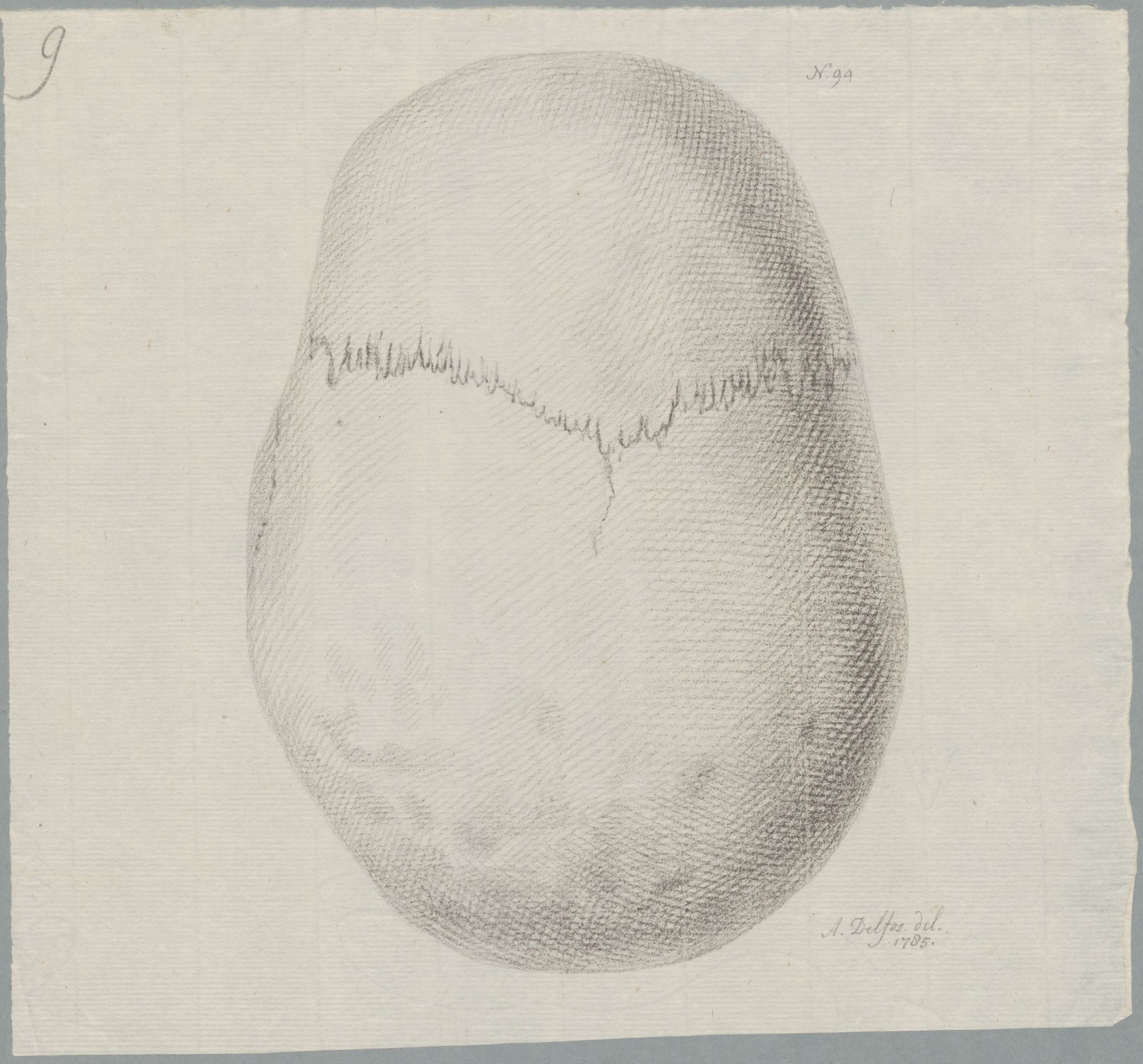 Specimens: hydrocephalus