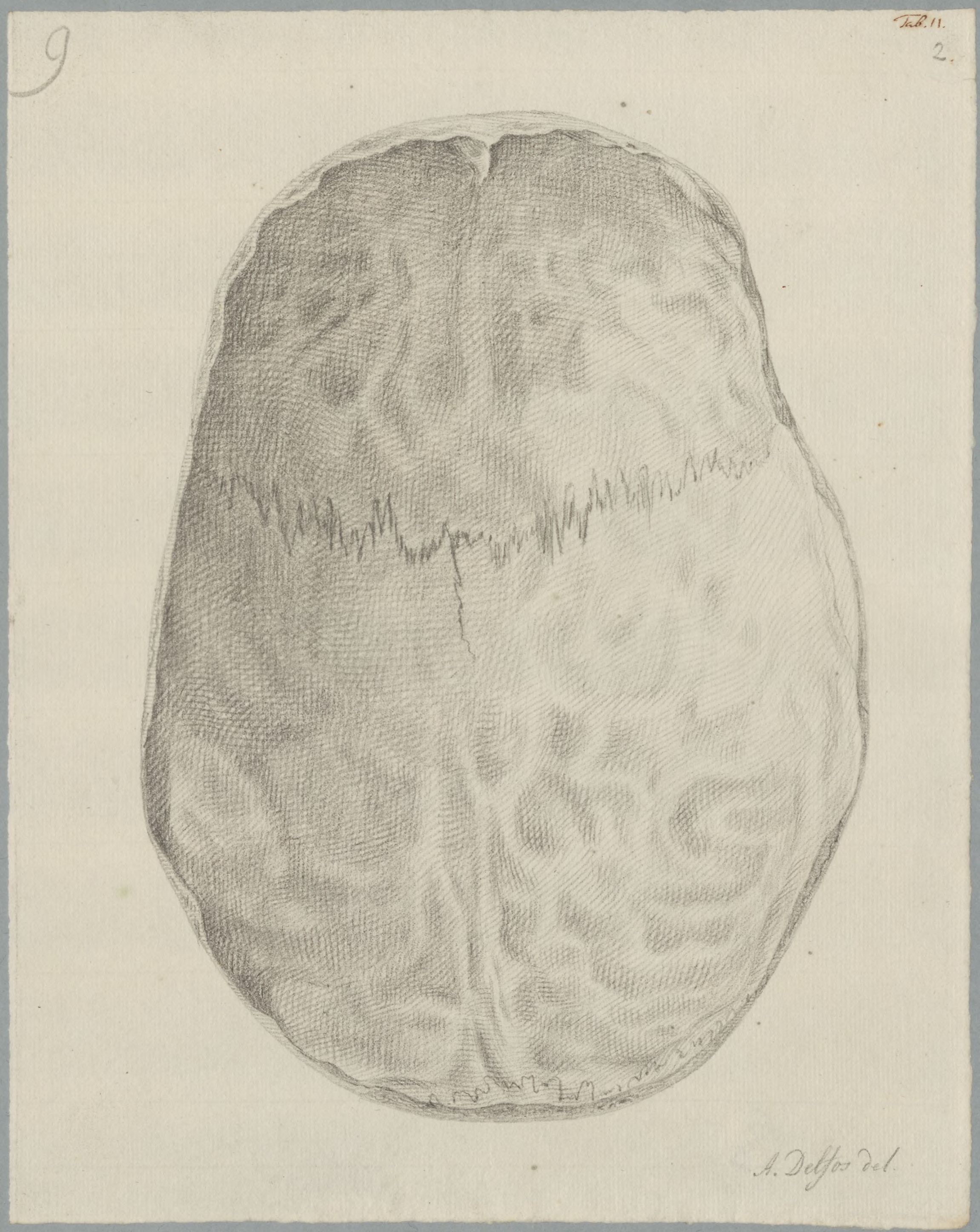 Specimens: hydrocephalus