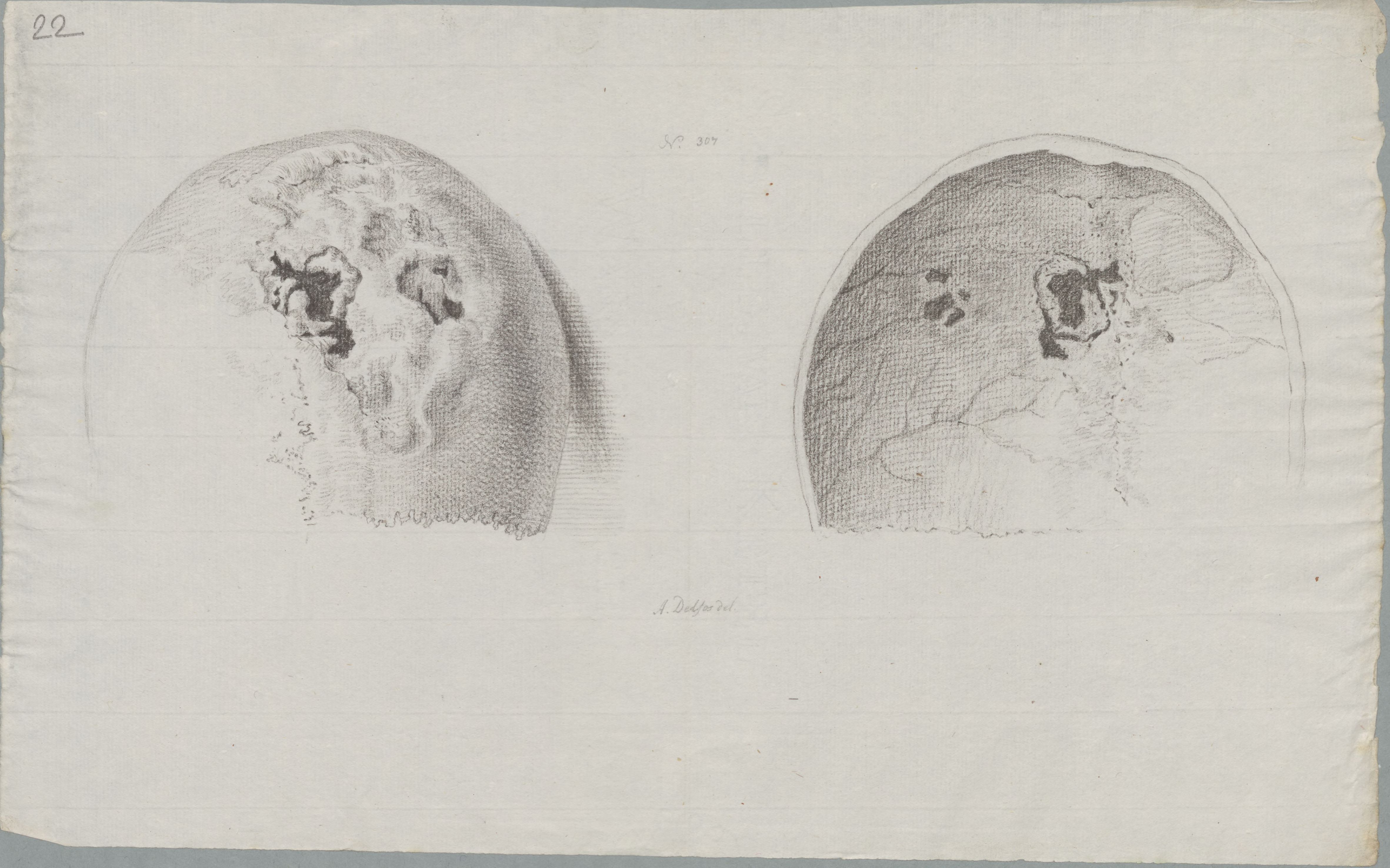 Specimens: skull, syphilis