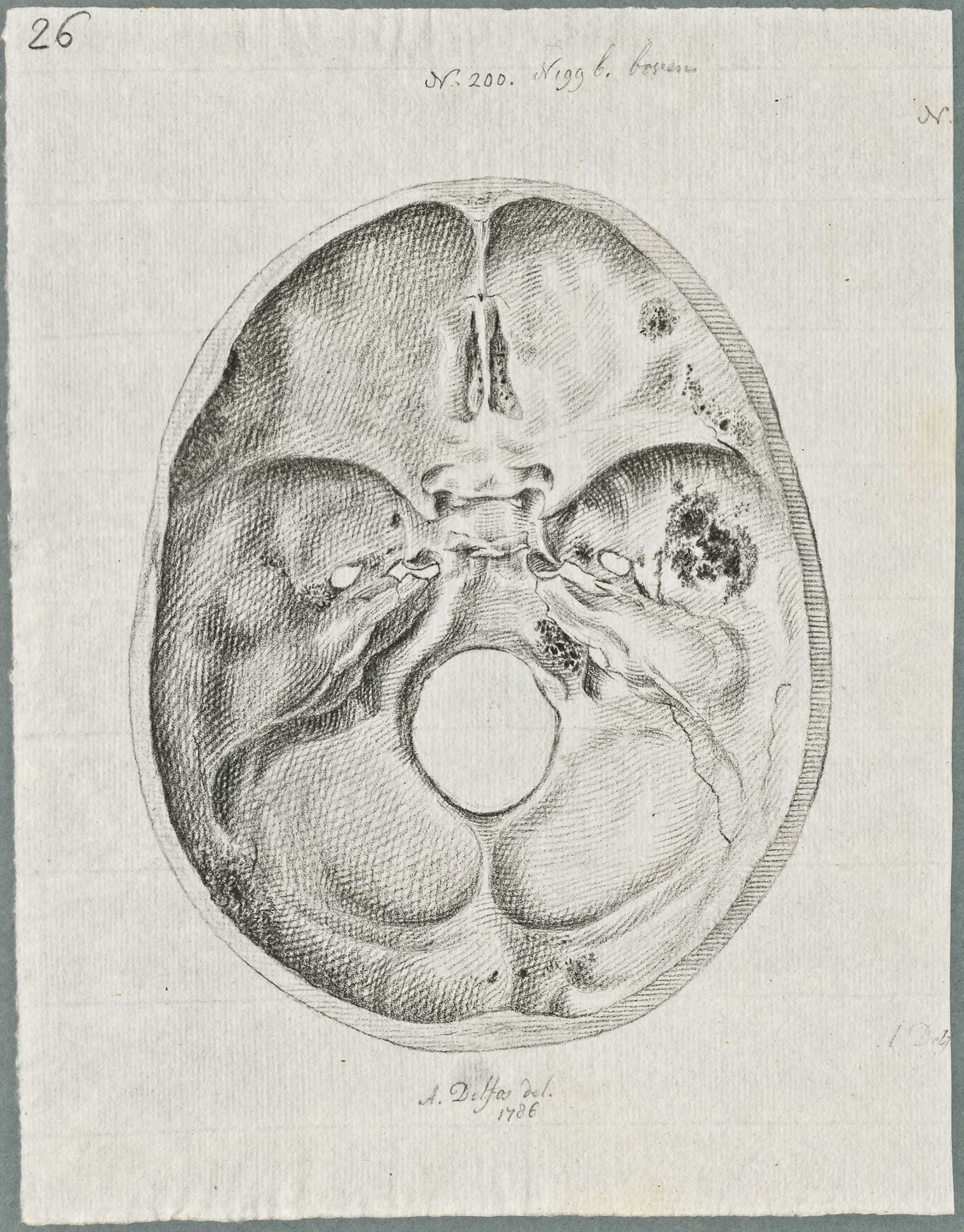 Specimens: skull, syphilis