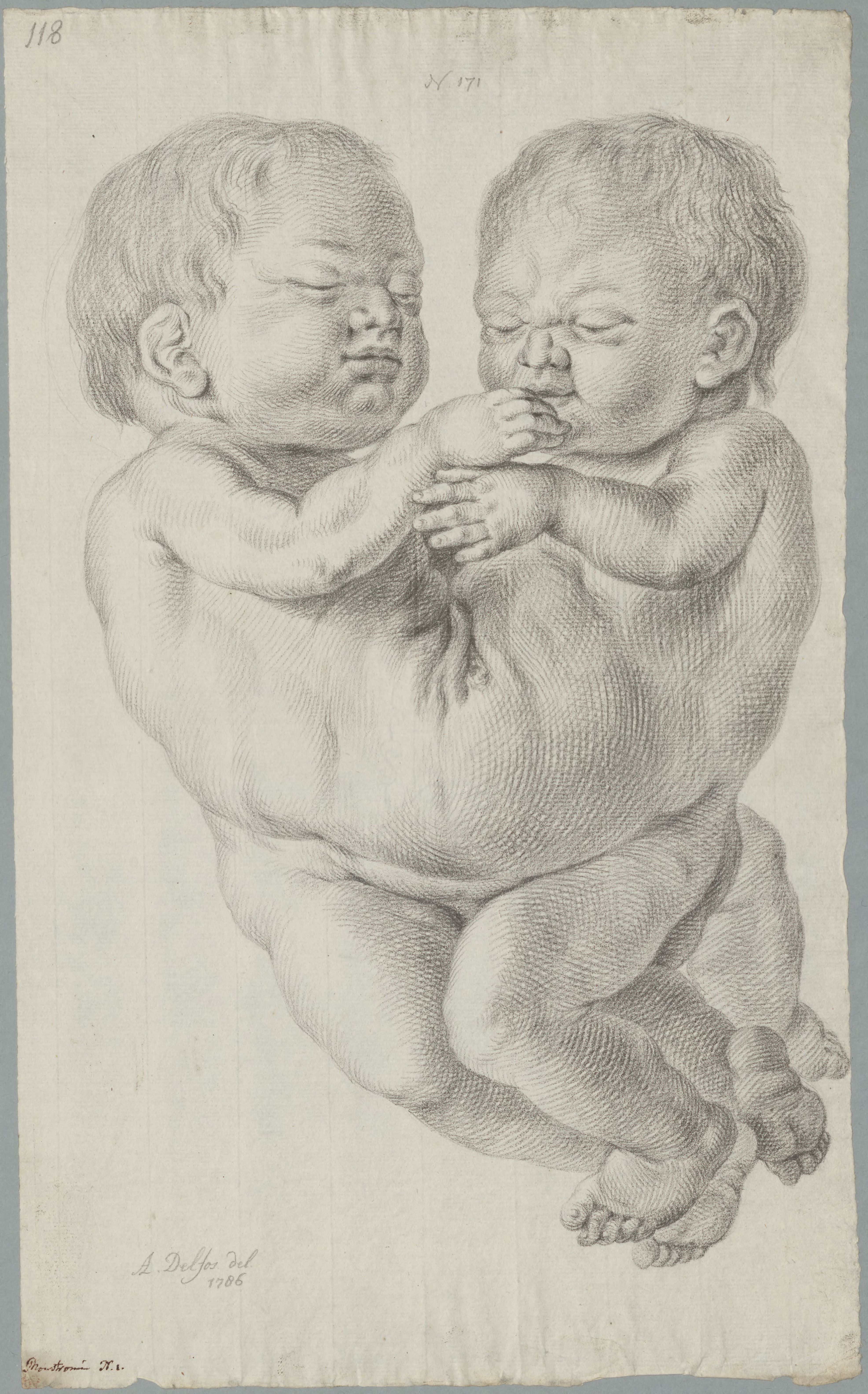 Specimens: conjoined twins