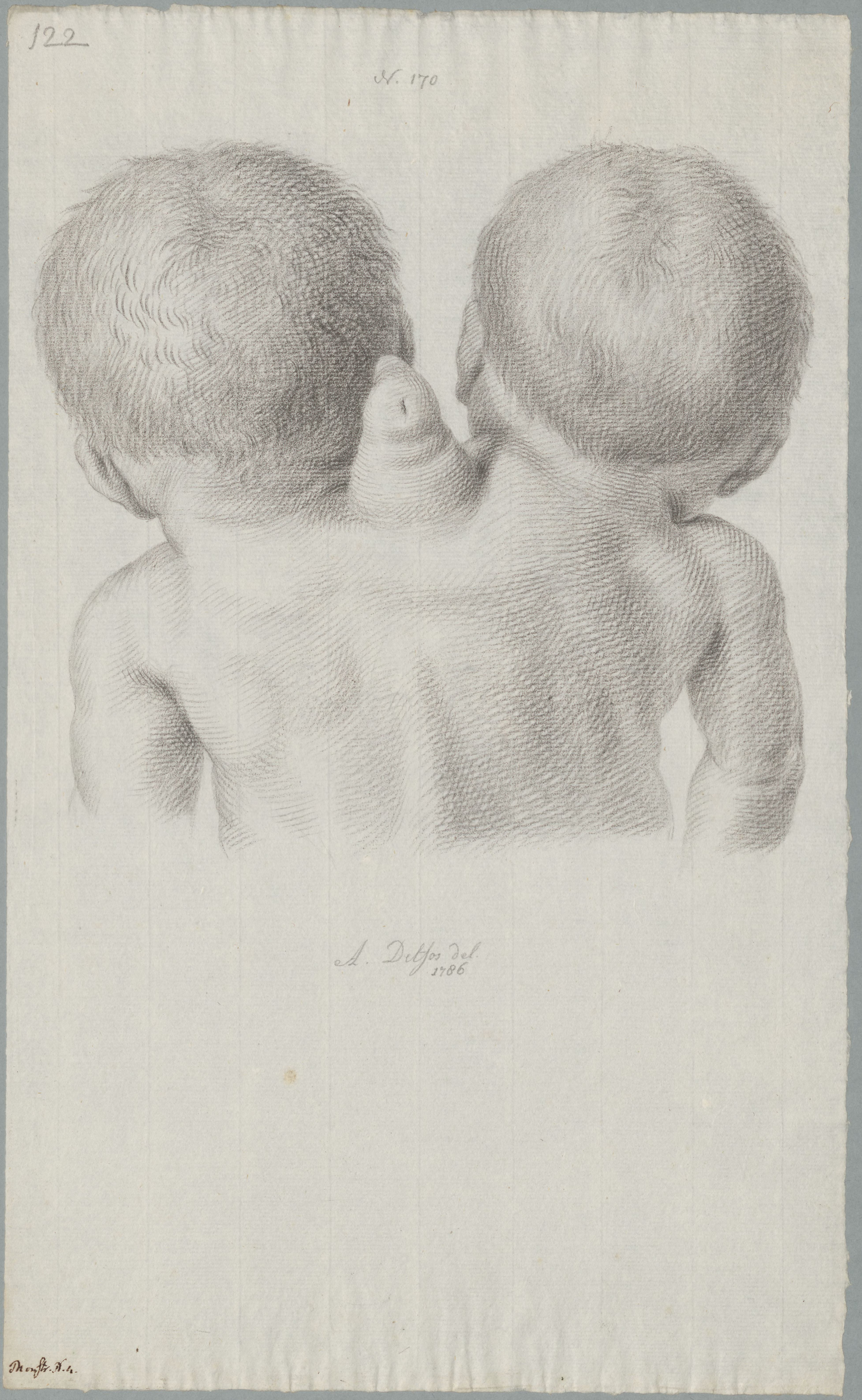 Specimens: conjoined twins