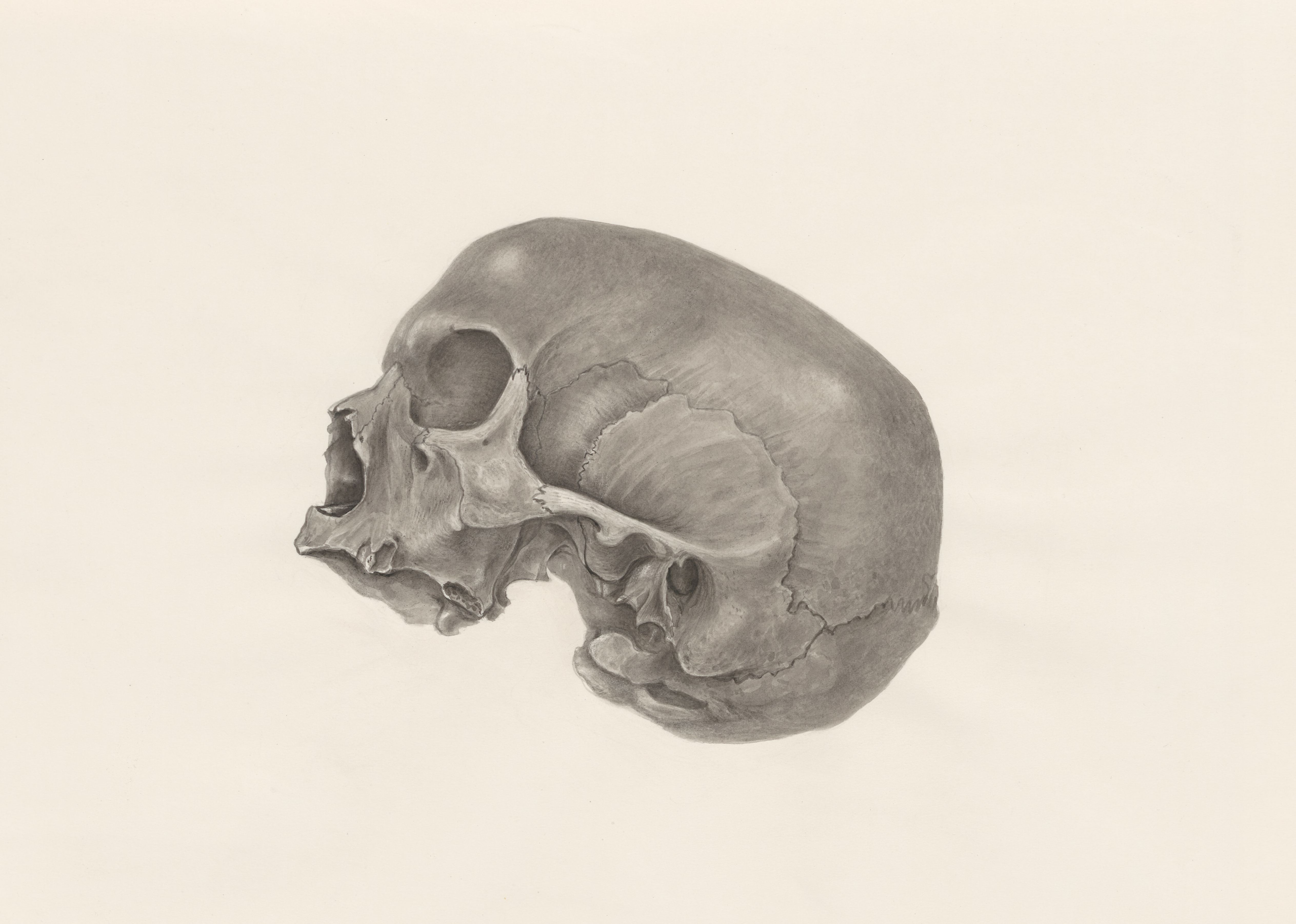 Deformed skull
