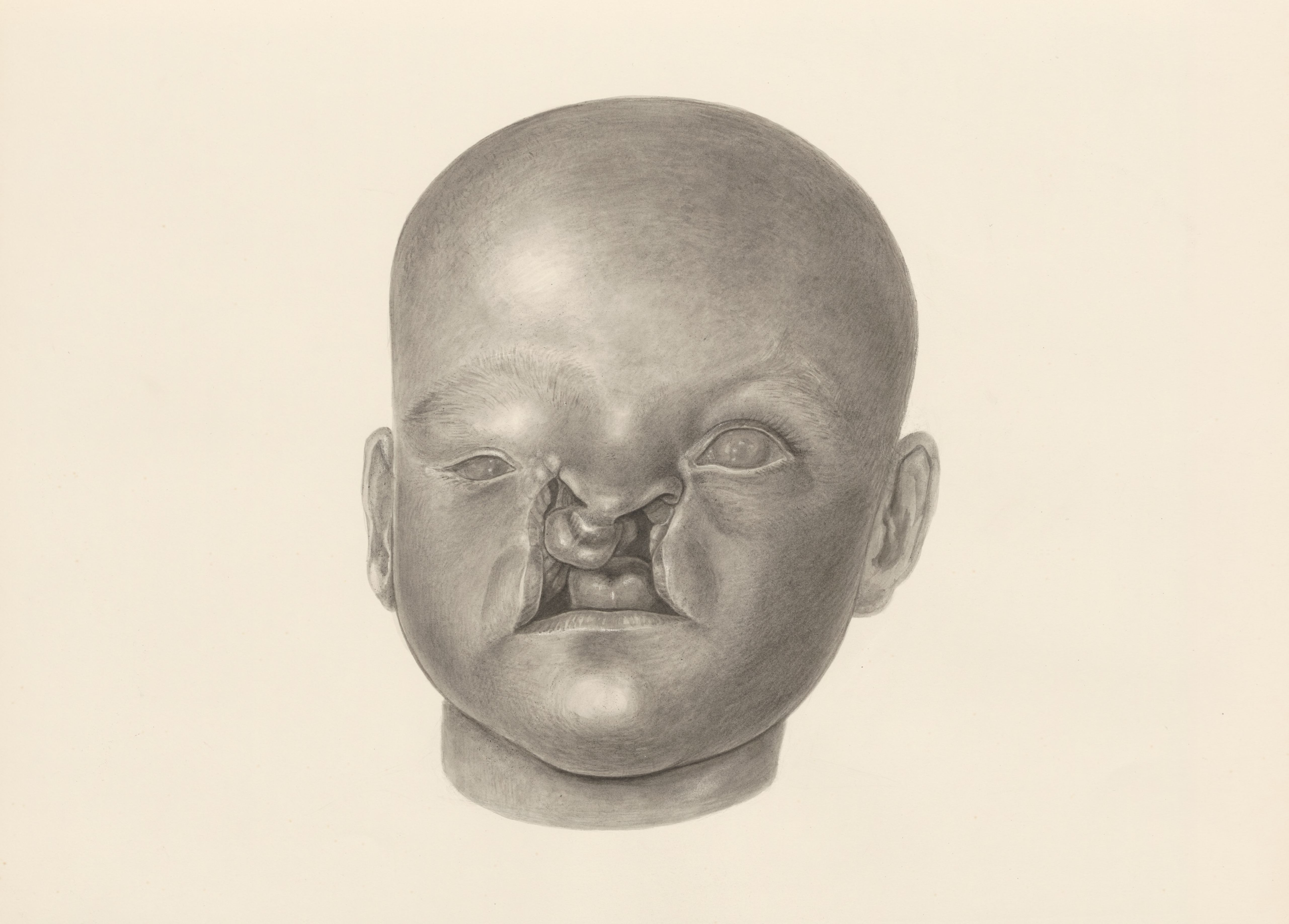 Deformed fetal head