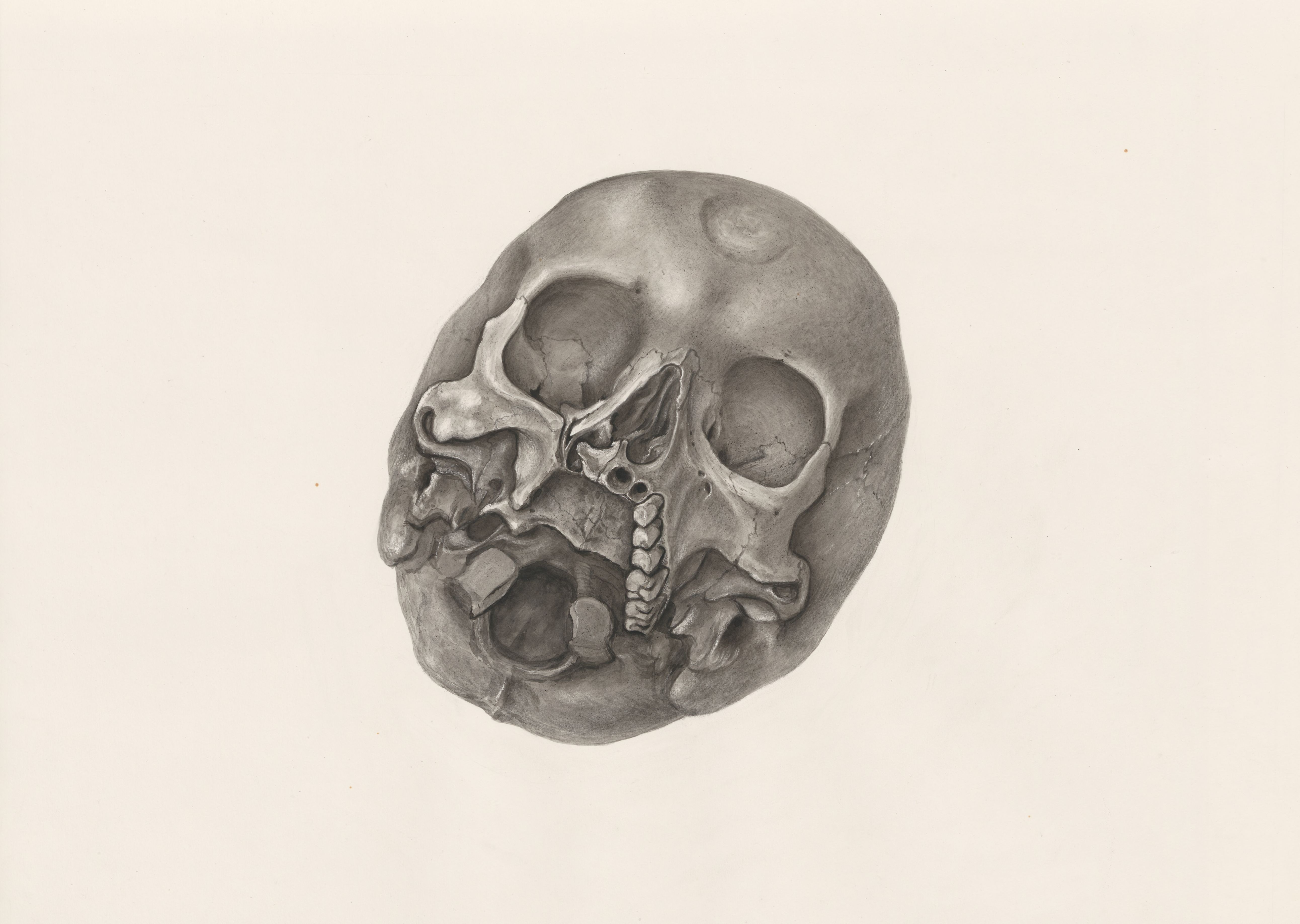 Deformed fetal skull