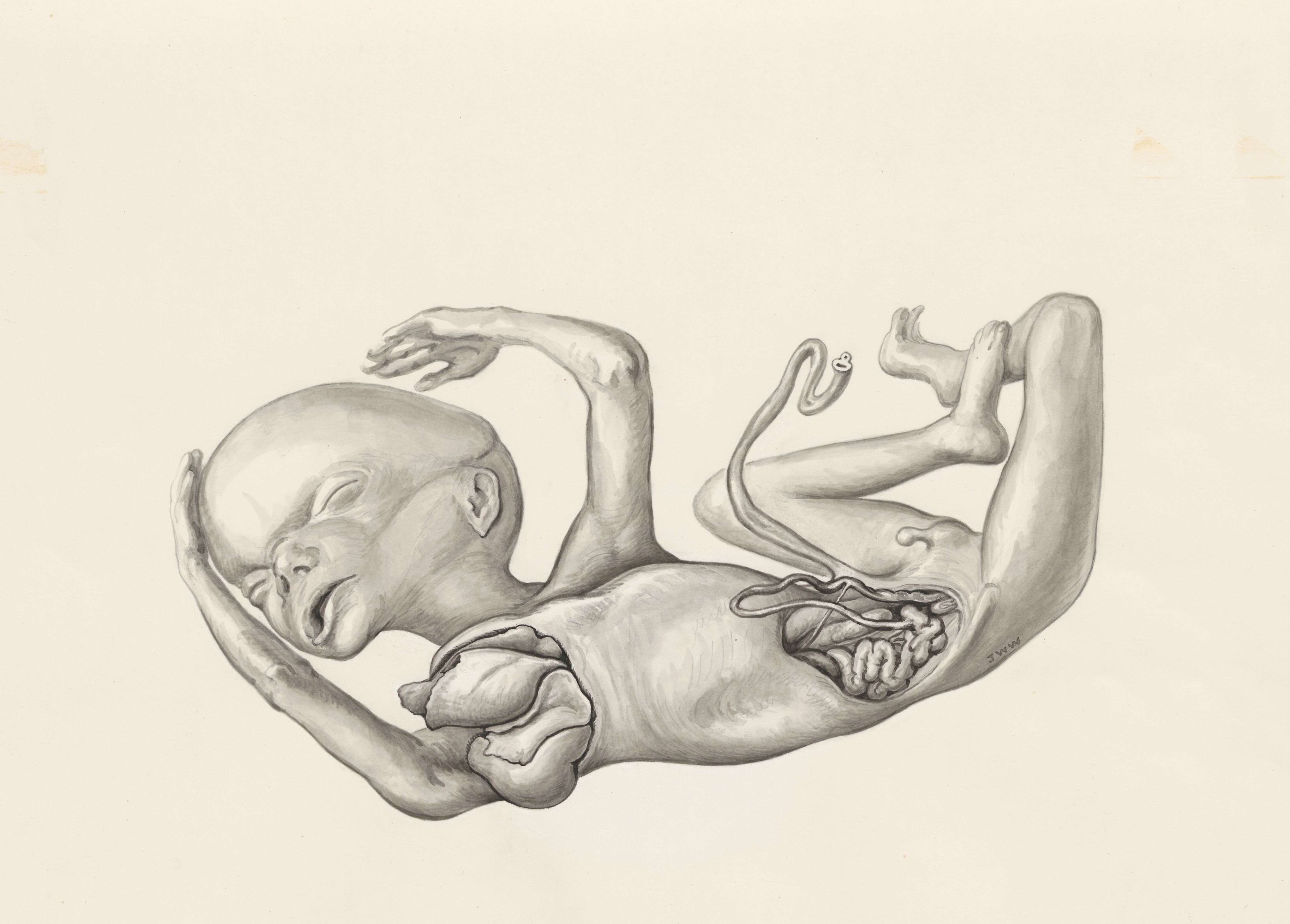 Fetus with open abdominal cavity