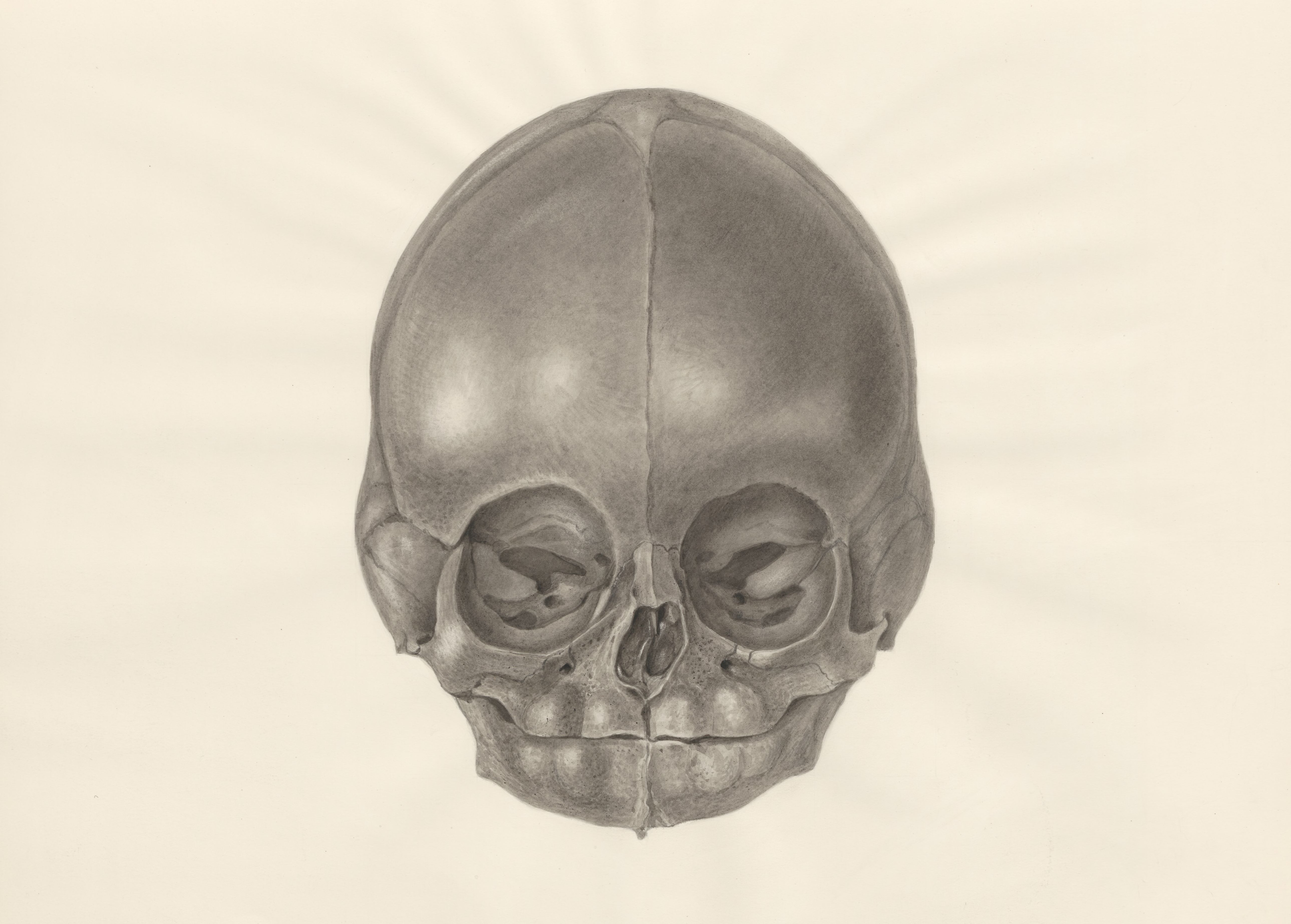 Deformed fetal skull