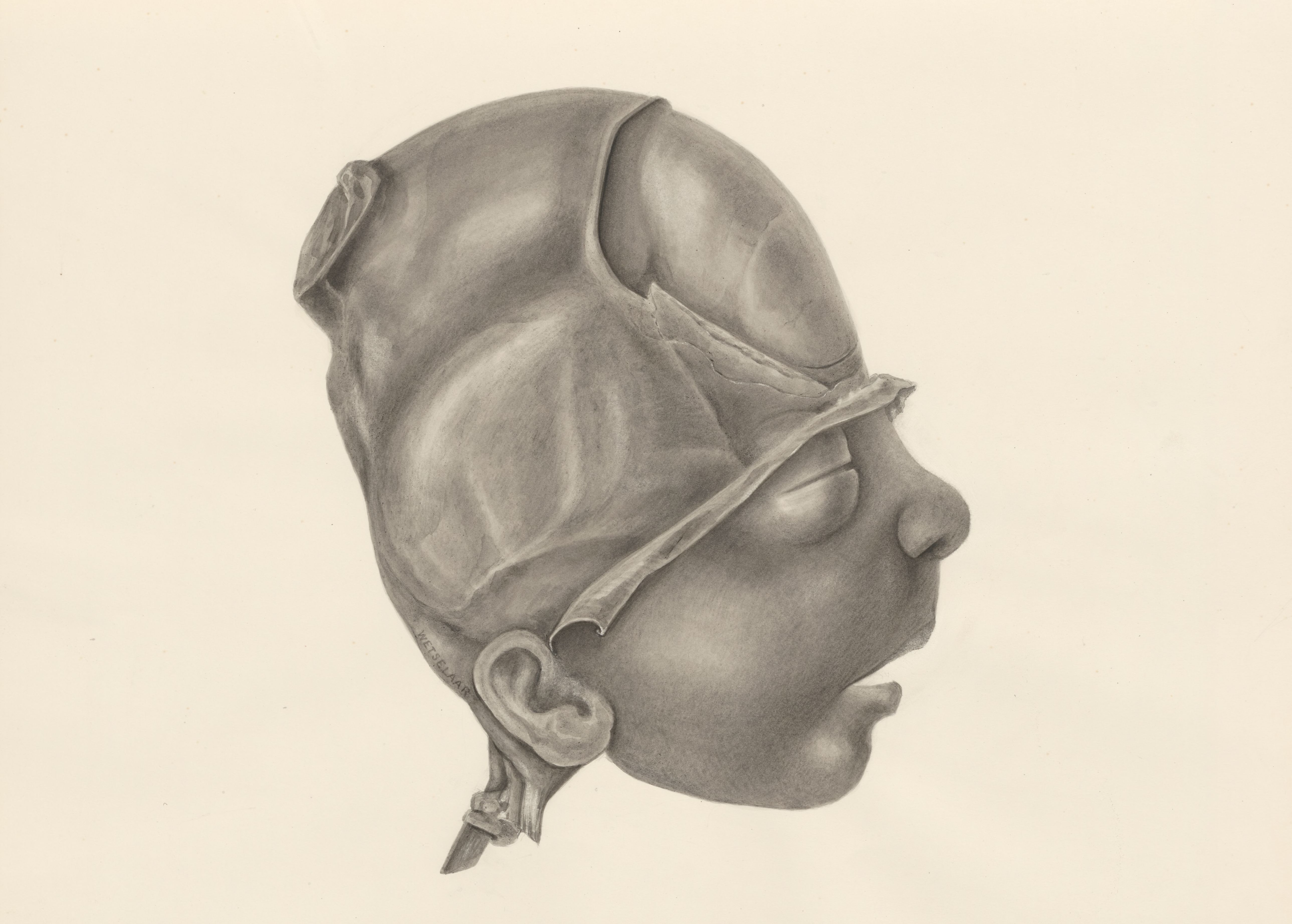 Deformed fetal head
