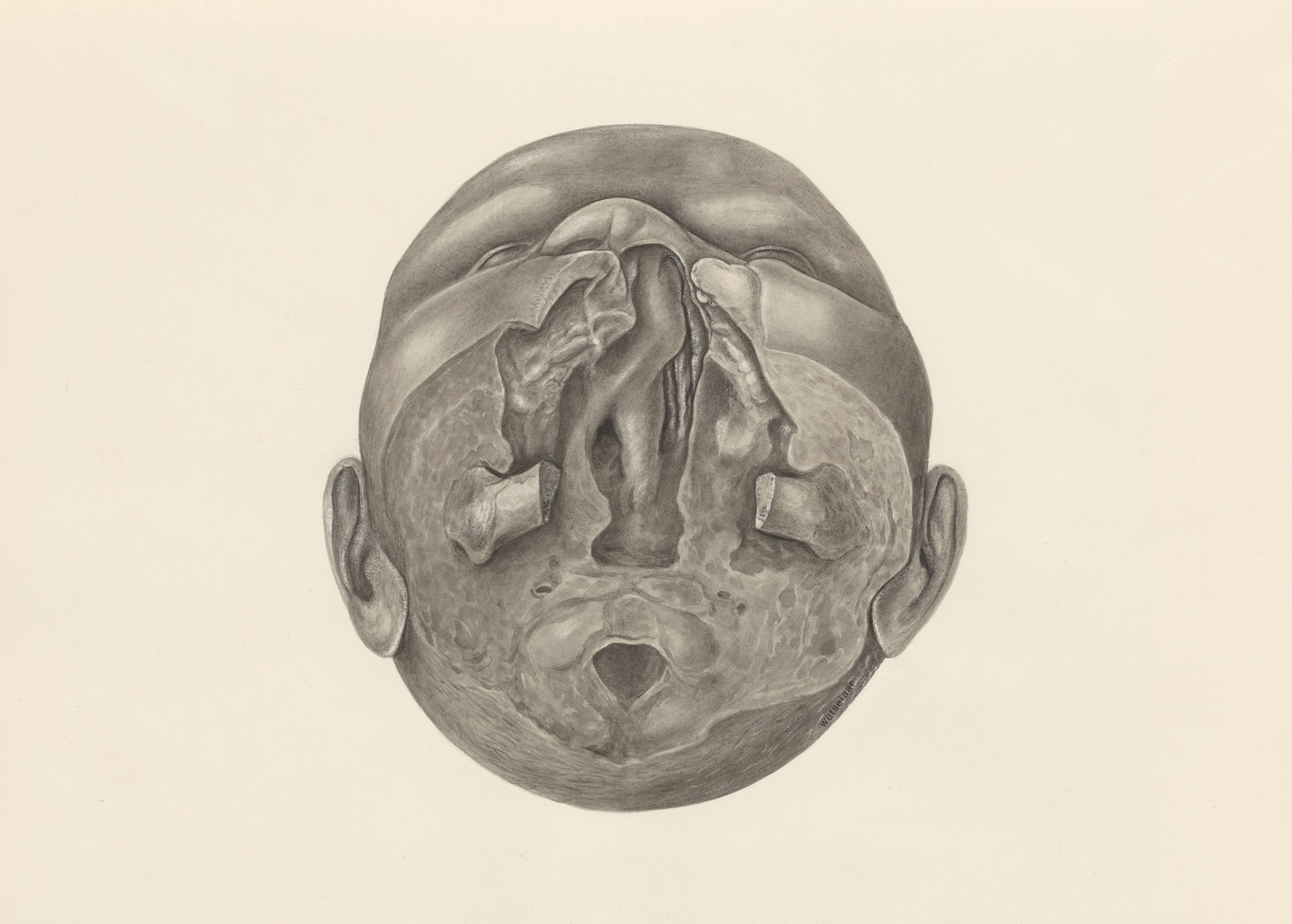 Deformed fetal head, seen from below