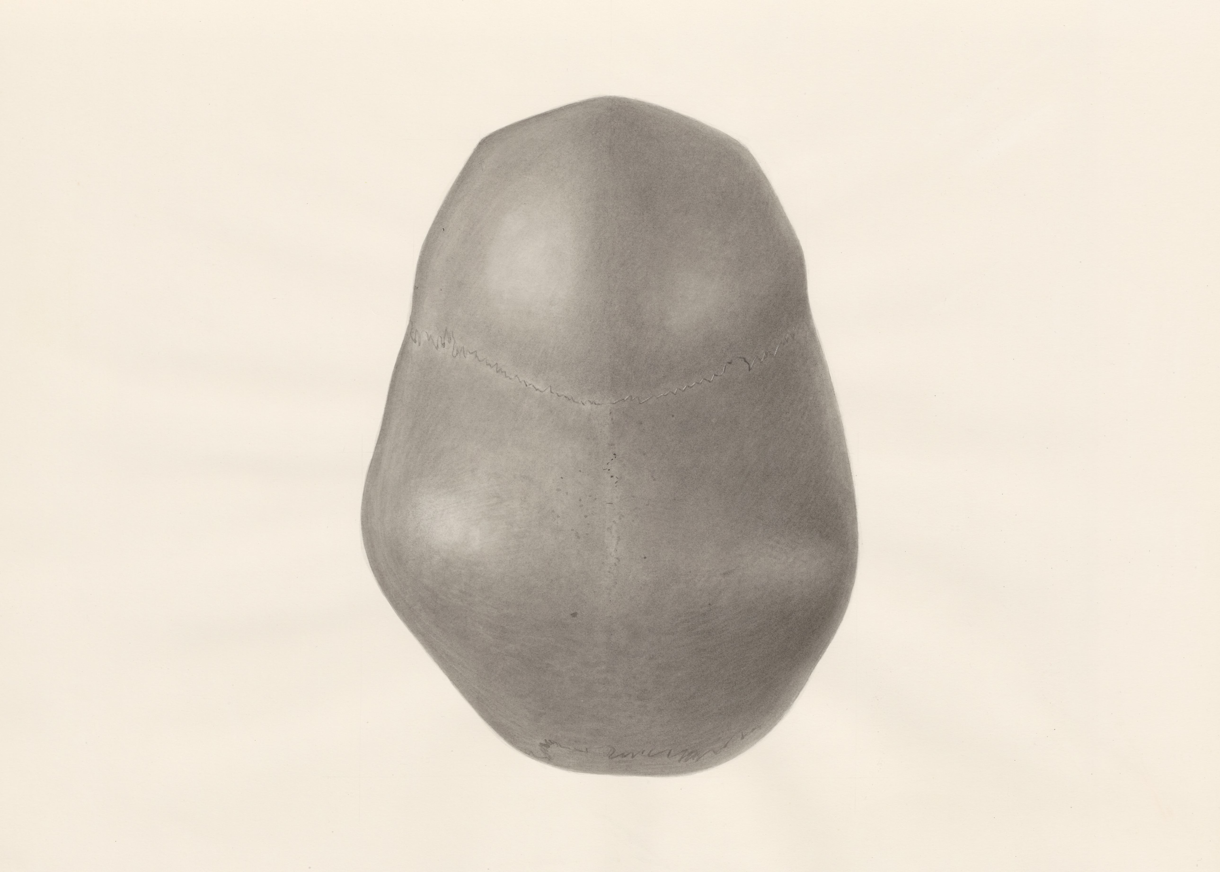 Deformed fetal skull, seen from above
